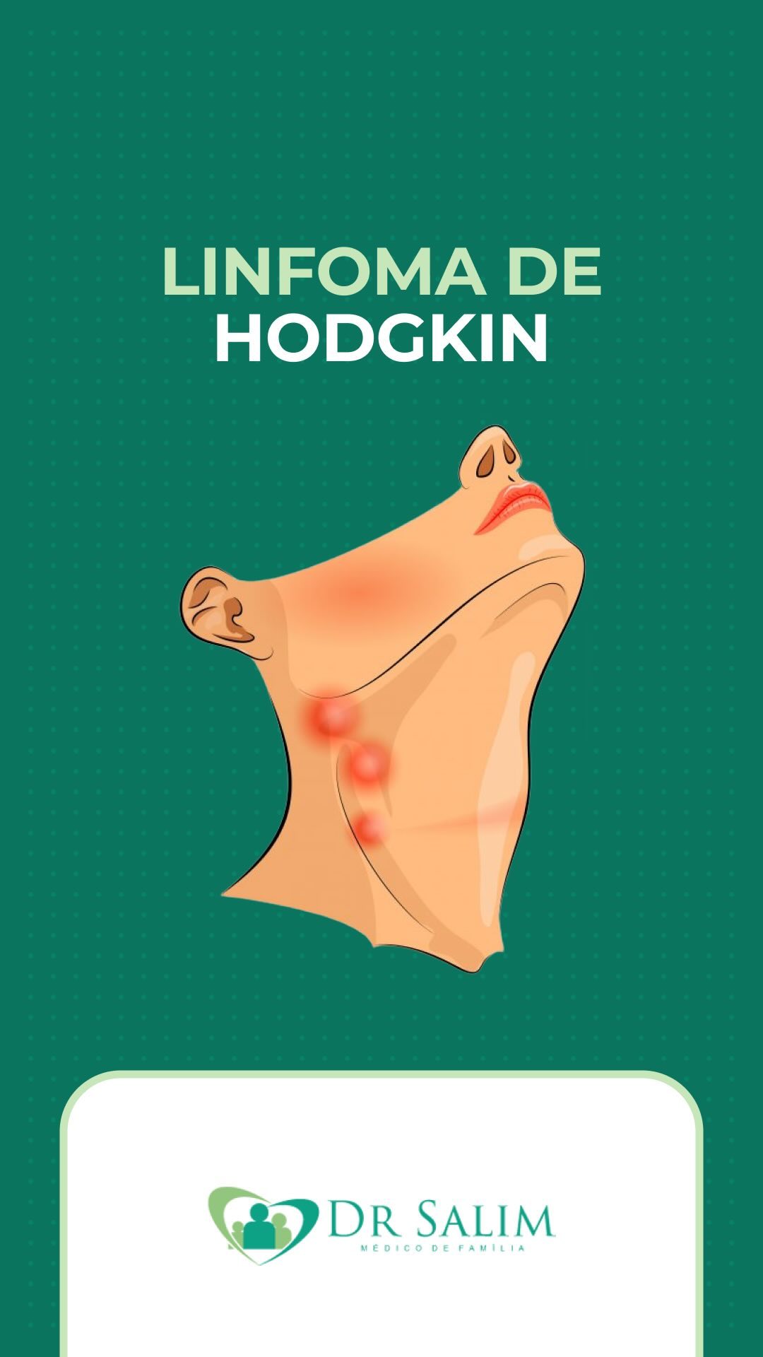 Neste vídeo, vamos falar sobre o Linfoma de Hodgkin, um tipo de câncer que afeta o sistema linfático, crucial para nossa defesa imunológica.
Abordo os dois principais tipos de linfoma, seus sintomas e as opções de tratamento disponíveis.
É importante ressaltar que os linfomas muitas vezes são curáveis, proporcionando uma fonte significativa de esperança para os pacientes. E mesmo quando a cura não é possível, existem tratamentos eficazes que ajudam a controlar a doença.
Abraços e até o próximo vídeo!