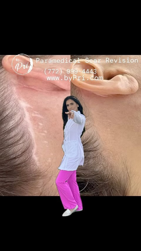 ☎️+1 (772) 999-4443
👉Scar Revision by Prí
📩 51 Royal Palm Pointe
📫Vero Beach, FL
•⭐️⭐️⭐️⭐️⭐️
•💥Scar Treatment @_bypri_
•🔥🔥
Scar Treatment.
This treatment reduces the overall size, helps bring back lost pigmentation, and improves the texture of your unwanted scars. #strechmarksrevisionbyPri #camouflagetattoobyPri #tattooverobeach #paramedicaltattoosbyPri #medicaltattooverbeqch #Microblading #stretchmarkcamouflageverobeqxh #stretchmarks #stretchmarksfl #stretchmarkbyPri #stretchmarkremovalvero #stretchmarknomore #stretchmarksbegone #stretchmarktreatment #stretchmarktattoo #stretchmarksremoval #brows #stretchmarksolution #stretchmarktattoo #fortpierce #sebastian #verobeach #vero #Melvour #Ny #fl #scarcamouflage