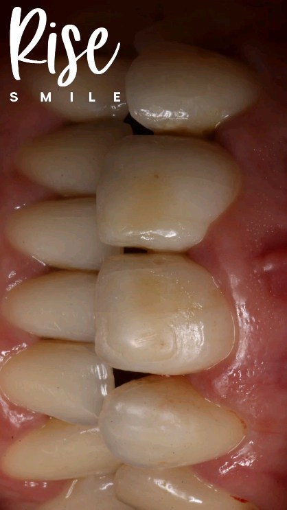 Carillas de resina compuesta, en este caso planificamos mejorar la forma/posicion y cerrar espacios entre los dientes, con un color estético y un resultado natural.
Realizado con resinas Empress Direct/ Ivoclar.
Te interesa este tipo de tratamiento?
Agenda tu hora de evaluacion😉