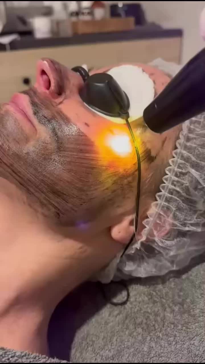 Onze nieuwste behandeling! De Carbon Peeling i.c.m. de Picolaser! Ook wel hollywoodtreatment genoemd….Dit wil je!!🤩 Schoonheidssalon Wilma Meins #schoonheidssalonwilmameins #centrumveendam #langmairacademy #carbonpeel #liefzijnvoorjehuid