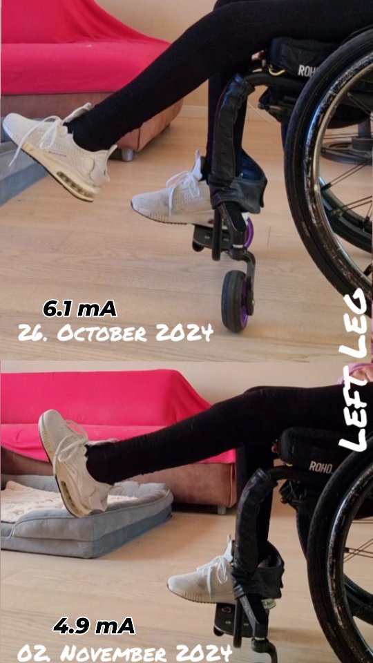 This video shows the progress of the muscle stimulation (left leg) of 1 week training with the (Boston Scientific) pacemaker (LION-Procedure). Even though there's only one week between both videos, I was able to decrease the stimulation from 6.1mA to 4.9mA BUT with better result in time of extension and consistency.
.
Fun-Facts:
spinal cord injury 8 years ago
Complete paraplegic (~Th10-12)
Lion-Procedure 16th of Oct 2024
mA means milliampere ⚡️
LION stands for Laparoscopic Implantation of Neuroprosthesis Procedure
.
LION procedure for spinal cord injury
By stimulating the nerves that control the muscles of the thighs causes an extension of the knee joints and thus a leg extension.
.
#spinalcordinjury #lionprocedure #marcpossover
#wheelchairlife