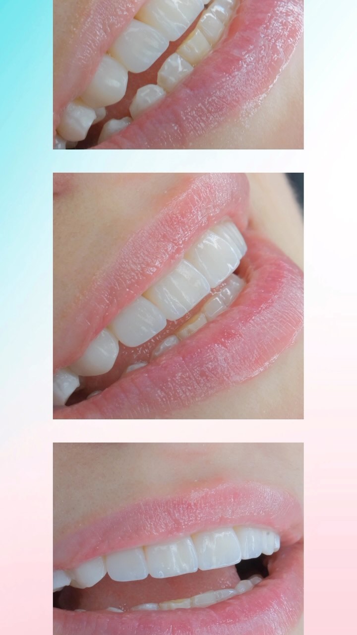 Estetinis plombavimas. Natūralu, šviesu ir gaivu!