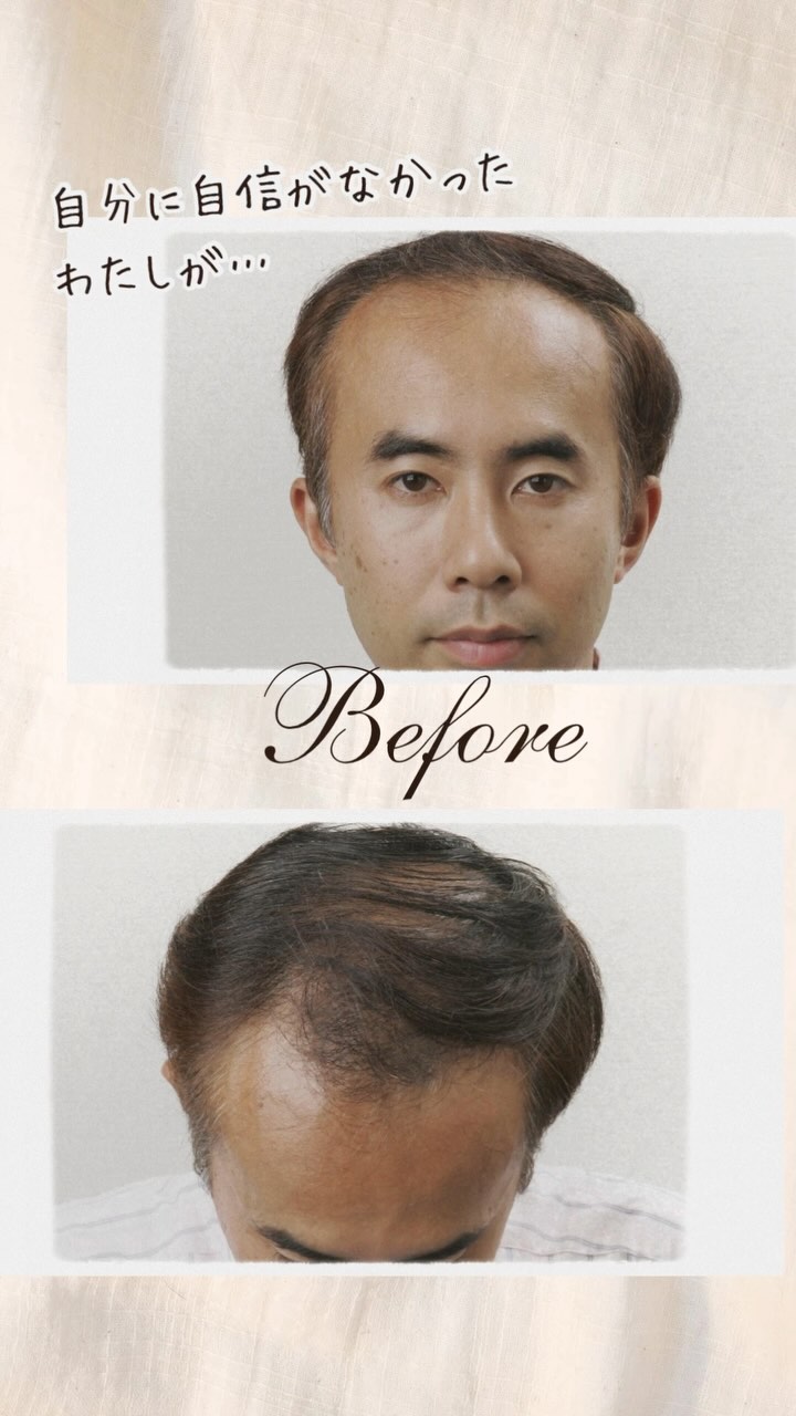 ■施術紹介
💁♂️中村様
施術名:自毛植毛
施術の説明:薄毛になりにくい後頭部・側頭部の毛根をに採取し、前頭部や頭頂部の薄くなった部分に移植する手術です。移植した毛髪は薄毛になりにくい性質を保ったまま定着し、一生涯、生え変わりけます。
施術の副作用(リスク):施術に伴い、痛み、赤み・熱感、初期脱毛、切れ毛・抜け毛、つっぱり感、感覚の鈍さ、施
術範囲のの悪化、コメド、毛嚢炎、膨隆、色素沈着、点状出血、内出血、腫脹、灼熱感、瘢痕が生じることがあります。
施術の価格:360,000円~
•*¨*•.¸¸☆*・゚•*¨*•.¸¸☆*・゚•*¨*•.¸¸☆*・゚•*¨*•.¸¸☆*・゚
他の投稿が見たい方は▼
@nidoclinic.sapporo
ご予約・詳しい詳細はプロフィール欄よりお進みください☺️
•*¨*•.¸¸☆*・゚•*¨*•.¸¸☆*・゚•*¨*•.¸¸☆*・゚•*¨*•.¸¸☆*・゚
AGAは正しい知識をもって治療を行う事が大切です。
まずはお気軽に無料カウンセリングにお越し下さい☺️
良ければ【いいね&(フォロー】をお願いします✨
いつでも見返せるように【保存】もよろしくお願いします🙇♂️
•*¨*•.¸¸☆*・゚•*¨*•.¸¸☆*・゚•*¨*•.¸¸☆*・゚•*¨*•.¸¸☆*・゚
ニドークリニック札幌
◼️所在地
📍北海道札幌市中央区南1条西6丁目11番 札幌北辰ビル7階
◼️営業時間
⏰9:30~18:00(受付17:00まで)
🗓️定休日:木曜、第1・3日曜、他隔週月曜
◼️お電話でお問い合わせの際は「Instagramを見た」と仰っていただけるとスムーズです。
📞011-281-0210
•*¨*•.¸¸☆*・゚•*¨*•.¸¸☆*・゚•*¨*•.¸¸☆*・゚•*¨*•.¸¸☆*・゚
#ニドークリニック札幌 #ニドークリニック #植毛 #自毛植毛 #植毛手術 #薄毛治療 #薄毛改善 #薄毛対策 #薄毛が悩み #薄毛 #aga #aga治療 #aga治療薬 #北海道 #札幌 #札幌駅 #大通り#薄毛女子 #女性の薄毛治療 #ハゲ対策 #ハゲ改善 #植毛札幌 #植毛職人 #植毛名医