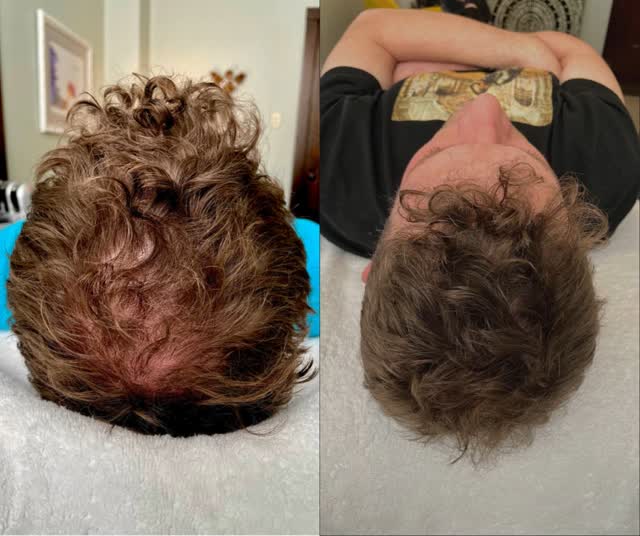 Poor scalp health is a major contributor to damaged and thinning hair.
Luckily there is a solution. Healthier hair starts with a healthy scalp!
Hydrafacial is not just for your lovely face. Hydrafacial can help you achieve healthier, thicker looking hair ! #kerivive #hyrafacial #scalphealth#scalptreatment #healthyhair
