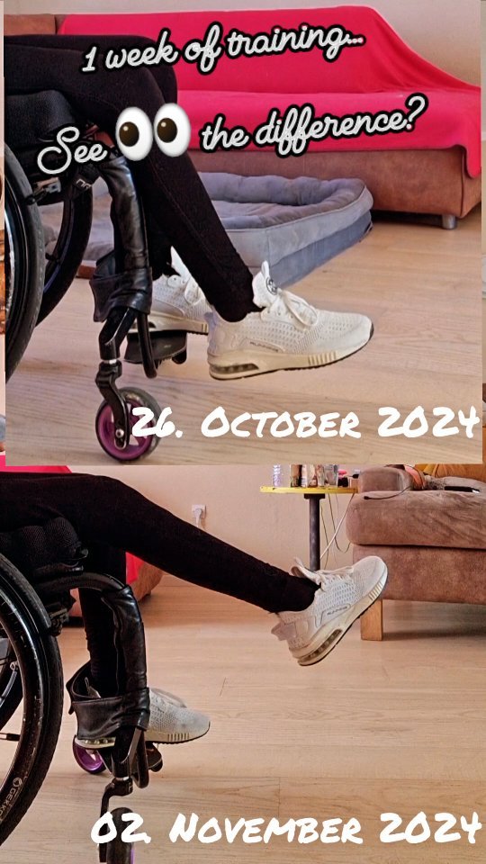 This is the progress of 1 week... showing the right leg which is stimulated by the pacemaker (Lion-Procedure).
#spinalcordinjury #lionprocedure #marcpossover #wheelchair