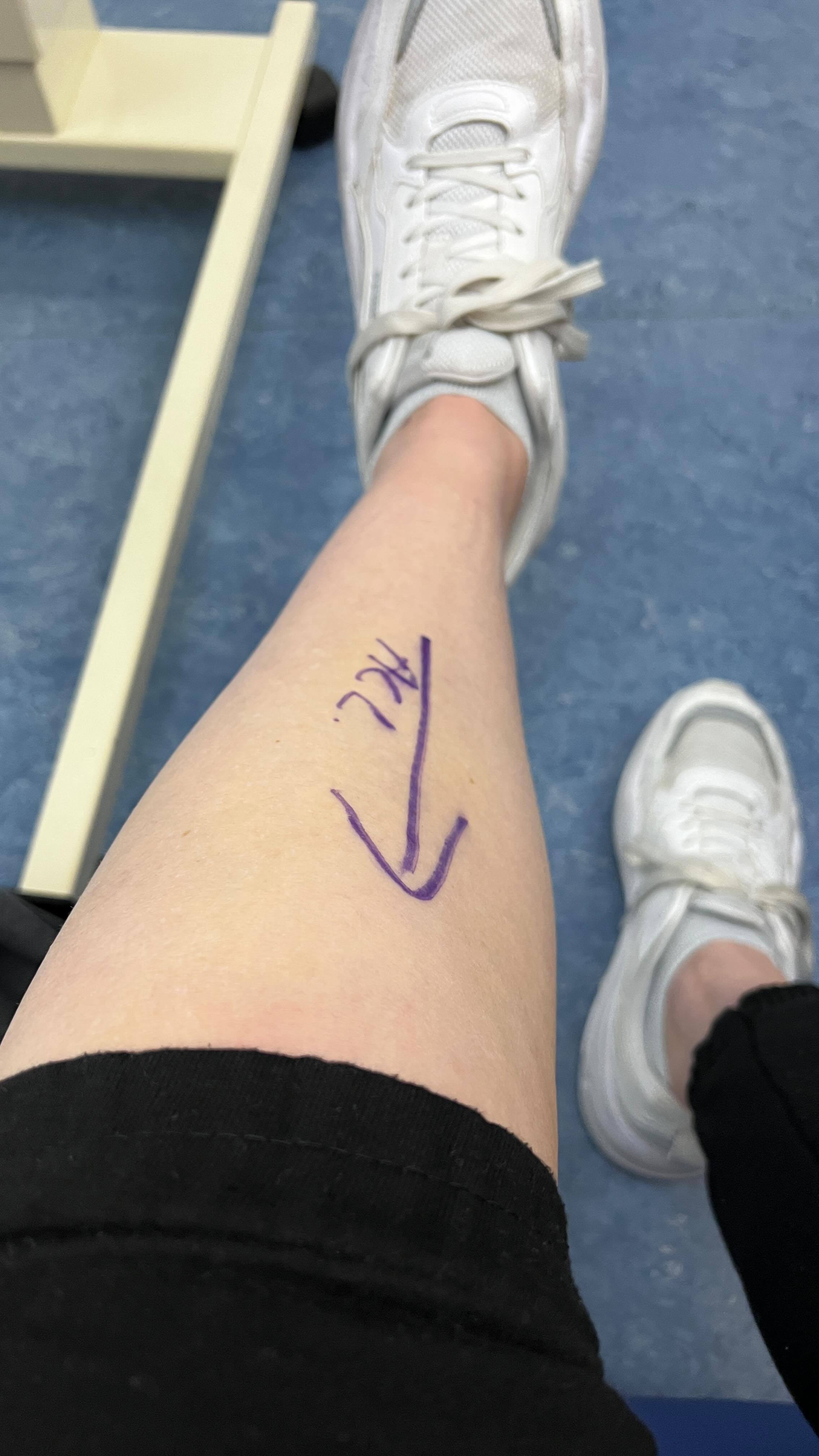 I thought I’d share with you all my recovery journey from ACL reconstruction surgery back in October 2022 to today. There have been so many ups and downs, happy days and sad days. I can’t thank Josh from Move physio enough for all the support he continues to give me. My strength is coming along SO well, but this isn’t saying it’s always been the case. It’s really made me appreciate the smaller things in life. How much I actually miss running for one!! Looking forward to seeing how I get on over the next 6 months! 🥳🥳
