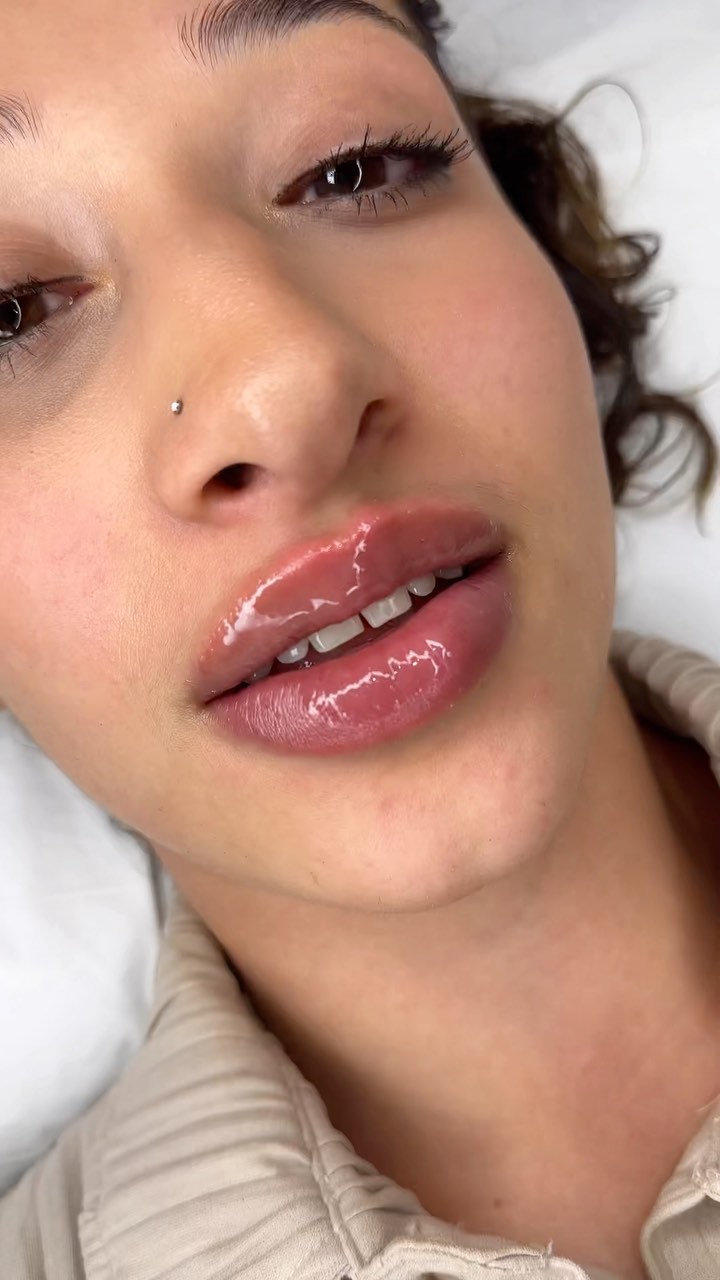 Come with me and create a perfect smile with 0.5ml of dermal filler.
Typically, fillers last for 6-12 months, depends on the type of fillers. However, you can make the best out of your filler and make it last longer by taking care of your body and follow-up treatments of lip enhancement.
5 Major Lip Filler Benefits & What To Expect:
Enhanced Appearance.
Natural Fullness.
Gradual Progression.
Little to No Side-Effects.
Lip Filler Recovery is Fast.
#lipfiller #lipfillerbeforeandafter #lips