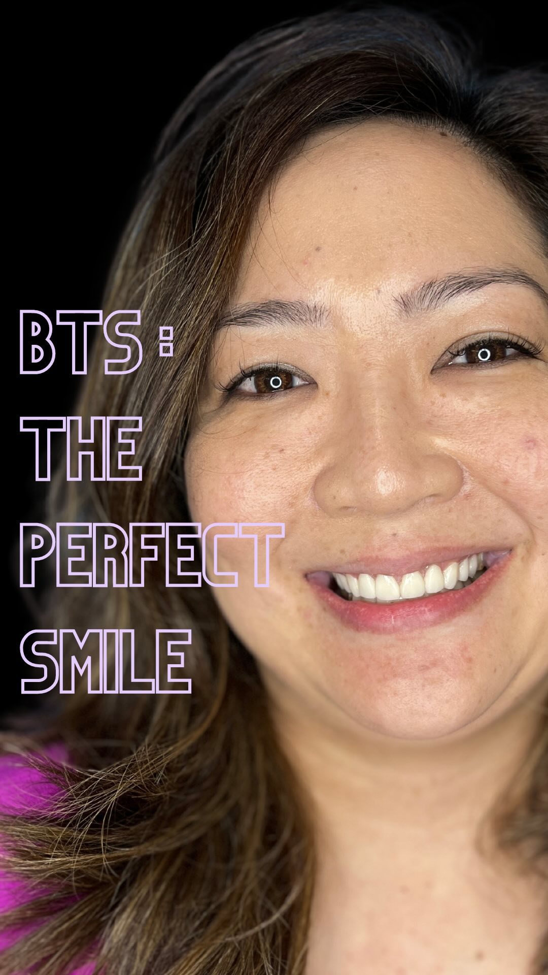 A peek behind the curtain : A comprehensive smile makeover done for our gorgeous patient with a combination of Ceramic Veneers + Laser Gum Recontouring 🤍✨
#smilemakeover #veneers #dentalveneers #smiletransformation #porcelainveneers #cosmeticdentistry #cosmeticdentist #aestheticdentist #aesthetics #gumcare #transformation #instareels #reelitfeelit