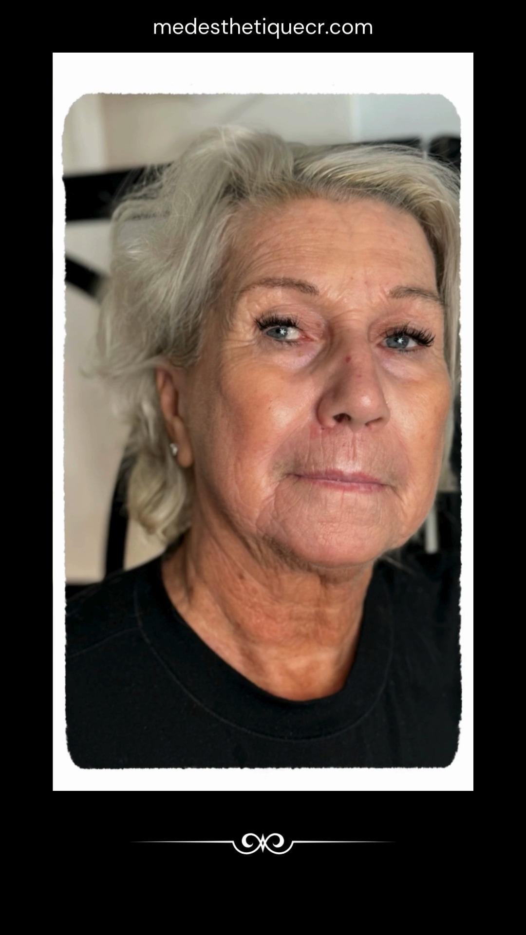 🔥 JUSQU'À 20% DE RABAIS SUR LE TRAITEMENT HIFU ! 🔥
✨Un soin de raffermissement avancé pour une peau éclatante✨
Le HIFU est une technologie innovante qui stimule la production de collagène pour une peau visiblement plus ferme et tonifiée. Une solution idéale pour celles qui recherchent un effet liftant naturel sans éviction sociale !
✅ Technologie avancée pour un soin personnalisé
✅ Résultats progressifs avec une peau plus ferme au fil des semaines
✅ Offre exclusive : jusqu'à 20% de rabais pour une durée limitée !
📍 MedEsthetique CR – Candiac
📅 Places limitées – Réservez votre consultation dès maintenant !
📩 Écrivez-nous pour plus d'infos 💬
#SoinHIFU #RaffermissementNaturel #ÉclatDeLaPeau #BeautéTech #PromoBienÊtre