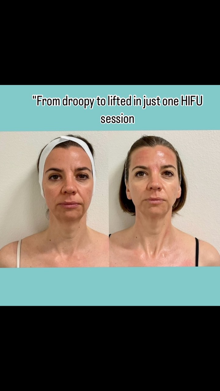 #capricebeautybar #age #theskingames2024 #tampabay #sarasotaflorida #skin #hifu #medspa #sarasota #skinlifting #venicflorida #stpeteflorida #annamariaisland #armandcircle #sarasotarealestate #womanpower⚡️