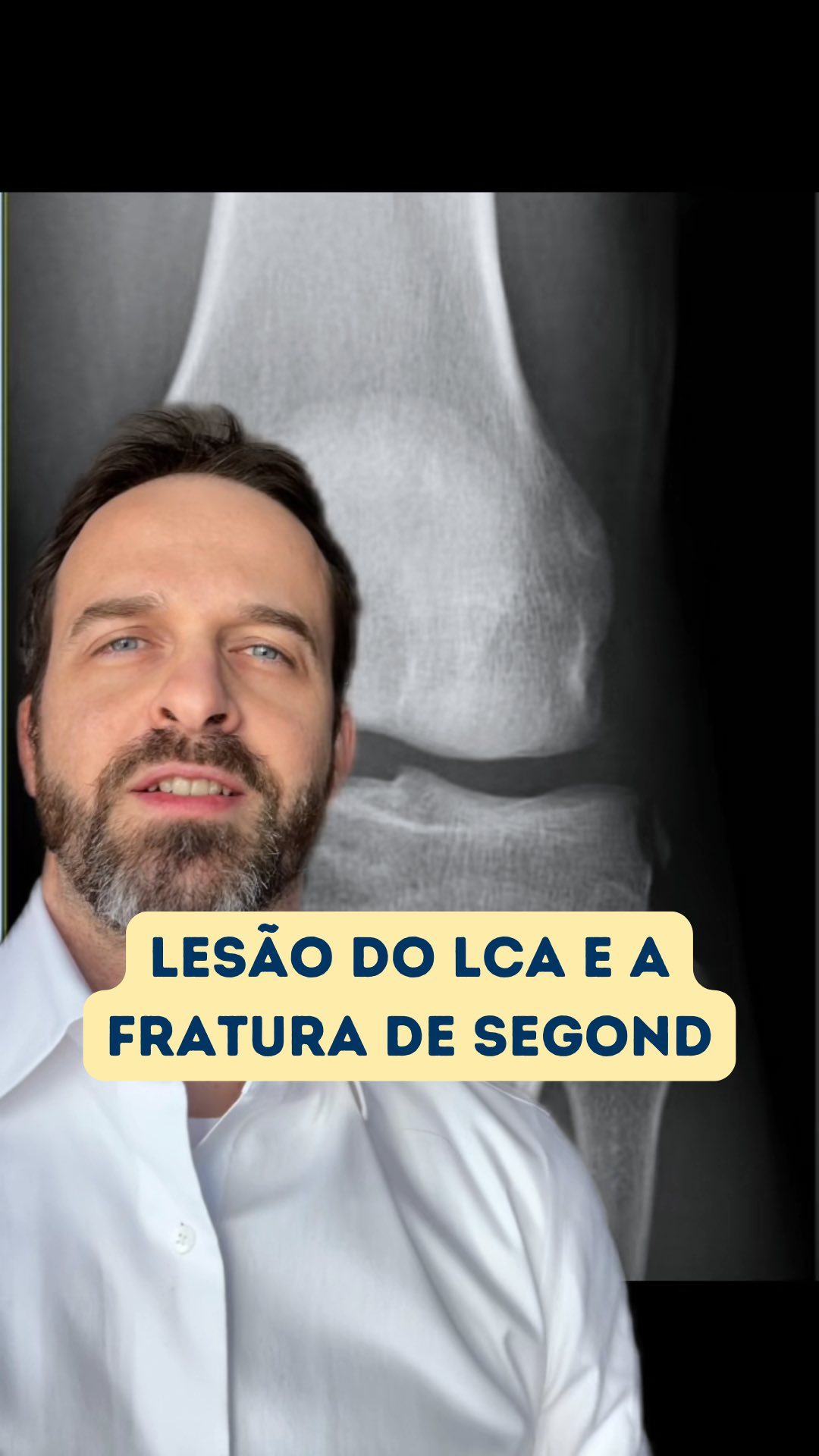 ⚡️A radiografia do joelho pode ajudar muito no diagnóstico da lesão do ligamento cruzado anterior. Saiba mais sobre a fratura de Segond, que tem forte relação com a lesão do LCA. #ligamentocruzadoanterior #joelho #artroscopia