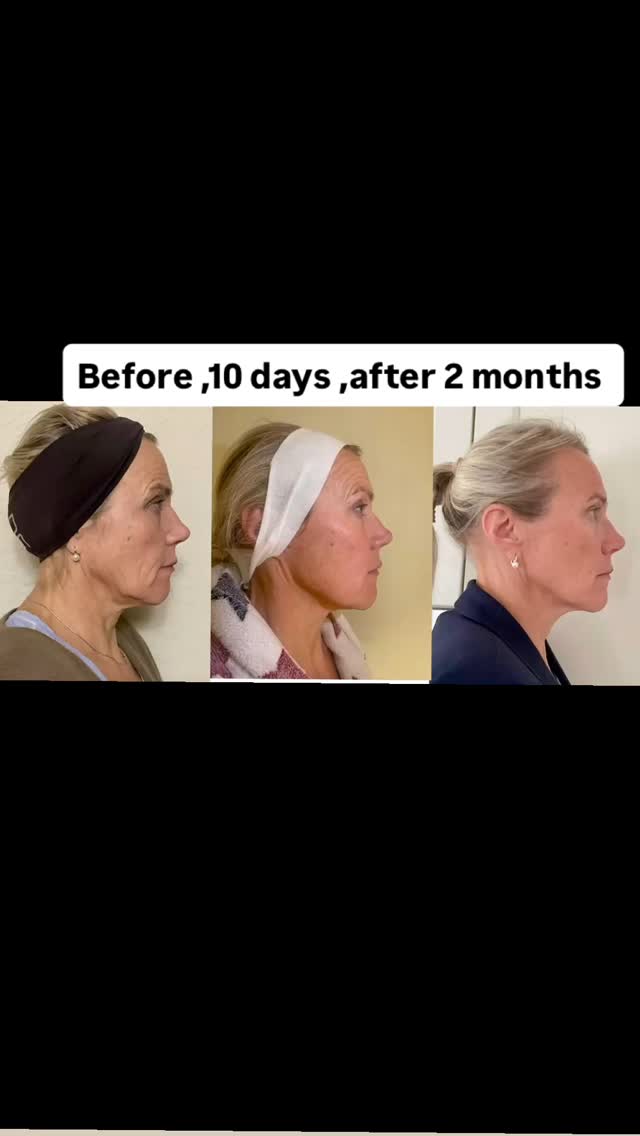 Update ‼️‼️ After 2 months CO2 skin resurfacing #capricebeautybar #theskingames2024 #age #tampabay #sarasotaflorida #sarasota #medspa #skin #co2laser #sarasotawomeninbusiness #sarasotawoman #lakewoodranchflorida #siberianbeautyskin