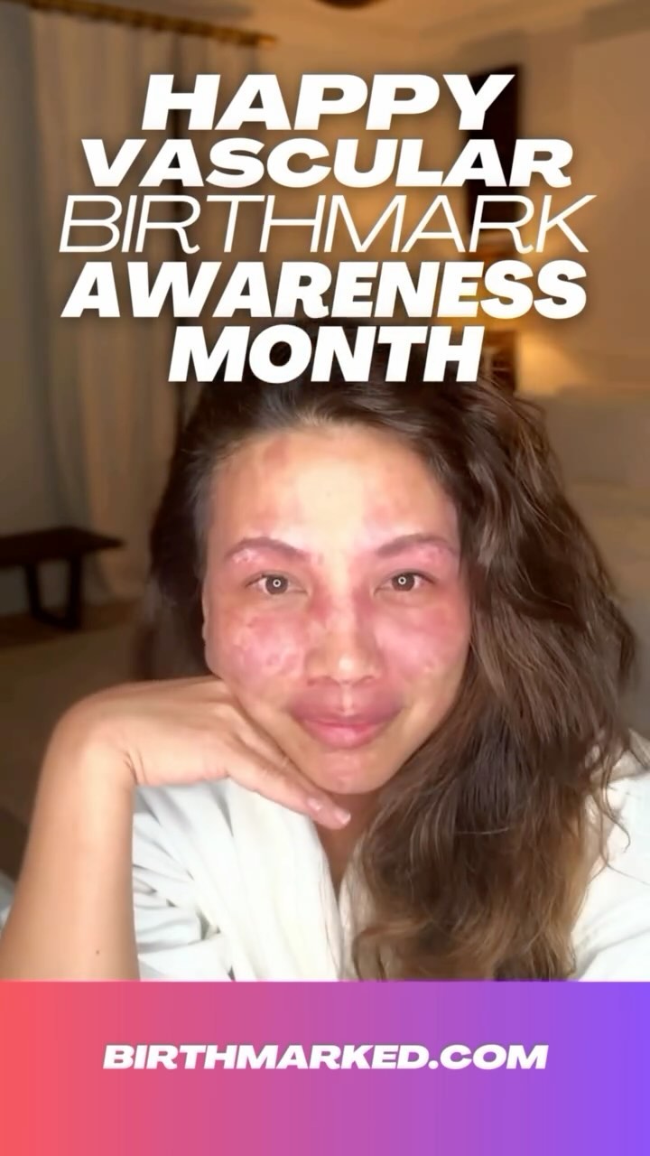 Happy Vascular Birthmark Awareness Month!
Be loud , Be proud, be you!!
Link in bio or visit to view and explore Birthmarked.com
#vascularbirthmark #portwinestain #vascularbirthmarkawarenessmonth
#vascularbirthmarksawareness #birthmarked