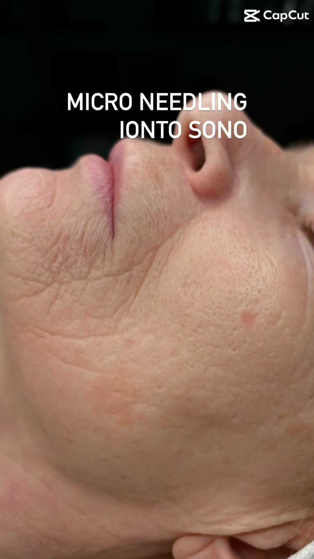 Microneedling#antiaging#premiumkosmetik#krefeld#iontocomed#bestehautpflege