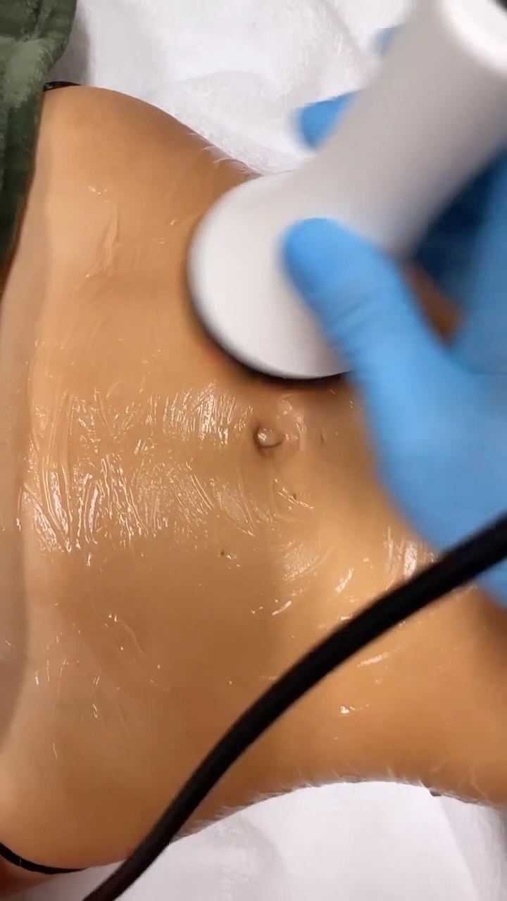 🌱RADIOFRECUENCIA 🌱:. La radiofrecuencia corporal consiste en un láser que penetra al interior de todas las capas de piel del organismo para mejorar cada una de ellas. Por lo tanto los resultados no simplemente se notarán en la capa de piel más superficial, sino que conseguiremos eliminar la flacidez desde el interior.
Como anteriormente hemos apuntado, la radiofrecuencia corporal estimula la aparición del colágeno en la piel, ayuda a la circulación y elimina todas las toxinas que provocan que nuestro cuerpo se vea flácido, arrugado y con celulitis. Es un método muy poco invasivo e indoloro que tiene muy buenos resultados.
Estos son los principales beneficios de realizar radiofrecuencia corporal para la flacidez:
Reduce las manchas de la piel, estrías y cicatrices
Mejora el aspecto de la piel
Ayuda a eliminar la celulitis
Contribuye a eliminar la flacidez para tener un cuerpo más firme
Ayuda a eliminar el exceso de grasa localizada
Hace que tengas una piel más luminosa gracias a la buena circulación
Elimina el exceso de toxinas de tu cuerpo. •
•
🌱RADIOFREQUENCY :Body radiofrequency consists of a laser that penetrates the interior of all the layers of skin in the body to improve each of them. Therefore, the results will not simply be noticeable in the most superficial layer of skin, but we will be able to eliminate sagging from the inside.
As we have previously pointed out, body radiofrequency stimulates the appearance of collagen in the skin, helps circulation and eliminates all the toxins that cause our body to look flaccid, wrinkled and with cellulite. It is a very non-invasive and painless method that has very good results.
These are the main benefits of performing body radiofrequency for sagging:
Reduces skin spots, stretch marks and scars
Improves the appearance of the skin
Helps eliminate cellulite
Helps eliminate flaccidity to have a firmer body
Helps eliminate excess localized fat
Makes you have brighter skin thanks to good circulation
Eliminate excess toxins from your body.