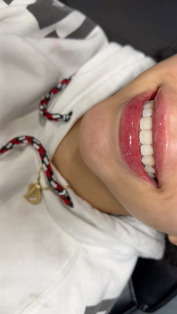 Y’all see it 💕😍 GO BOOK 🗣 #lipfillers #lipfillertampa #lipfillertraining #hyaluron #lipshaping #dolllips #keyholepout #lipfillerbeforeandafter #bradentonlashes #lipfillerbradenton #lipfillersarasota #nails #makeuptutorial #hairinspo