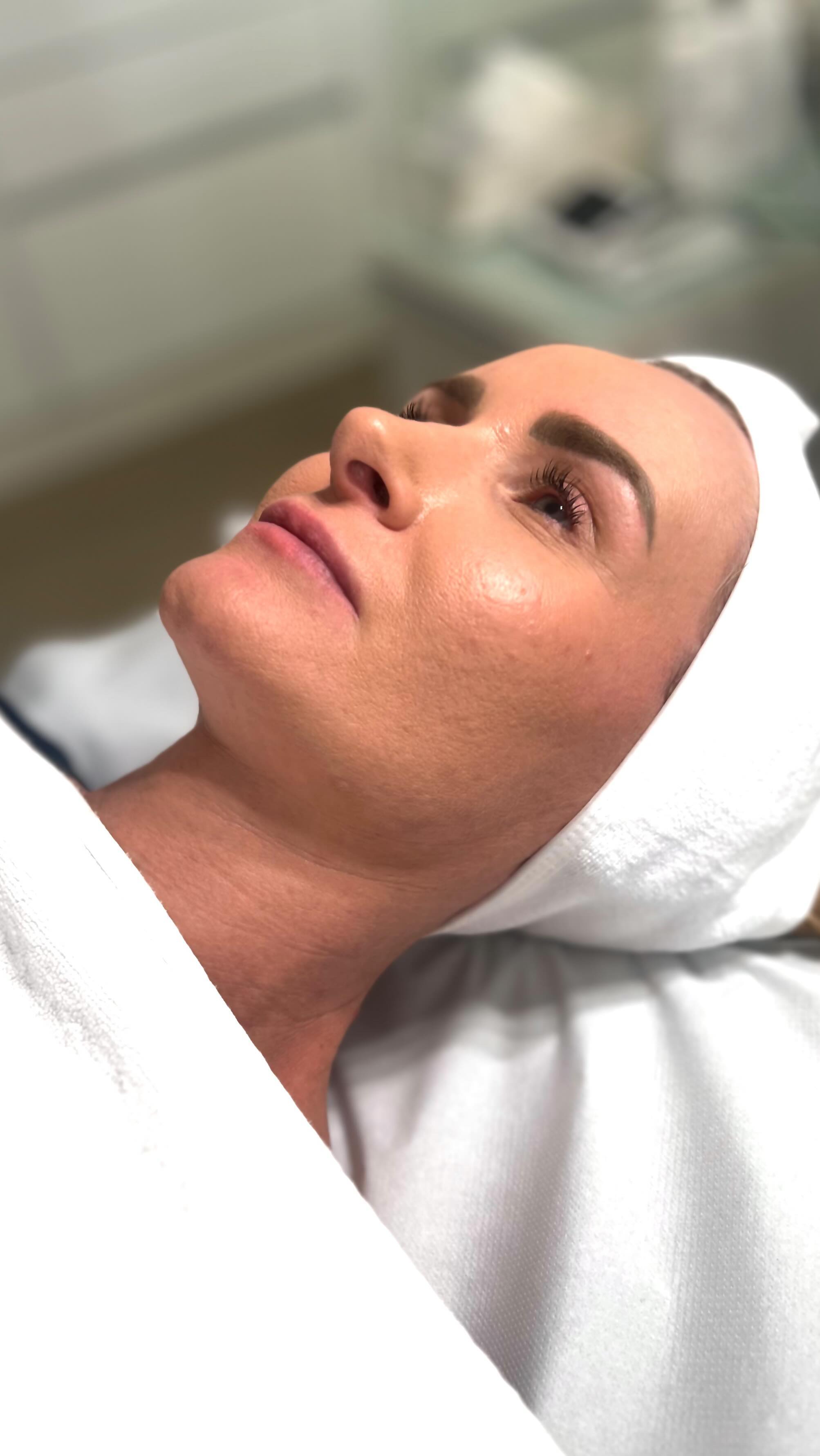 ✨Treatment Process Dermaneedling✨
Dermaneedling bietet als minimalinvasives Verfahren eine effektive Behandlungsmöglichkeit für folgende Anwendungsfelder:
🤍 Anti Aging
🤍 Narben
🤍 Hyperpigmentierung
🤍 Couperose
🤍 Haar Vitalisierung
Die Behandlung umfasst zunächst die Bewertung der Hautbeschaffenheit, gefolgt von der Analyse möglicher Behandlungsziele sowie einer ausführlichen Aufklärung des gesamten Behandlungsablaufs. Diese Aufklärung schließt die Nachbehandlung in Form von Homecare-Pflegeanweisungen sowie empfohlene Kurbehandlungen ein.
Die Dermaneedlingbehandlung selbst besteht aus einer vorangehenden Tiefenreinigung der zu behandelnden Hautpartie. Anschließend wird ein für die Behandlung und das gewünschte Behandlungsziel individuelles Serum ausgewählt, welches mit einem passenden Nadelmodul und entsprechender Needlingtechnik in die Haut eingearbeitet wird. Im Anschluss an das Needling wird die Haut mit beruhigenden Wirkstoffen im Studio sowie nährenden Homecare-Produkten und Pflegeanweisungen versorgt.
#dermaneedling #microneedling #facialtreatment #treatment #cosmeceuticals #dermasr #lovewhatyoudo #loveyourself