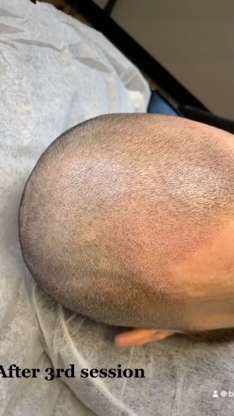 Scalp micropigmentation. Aka:
โก๏ธS M P โก๏ธ
We designed a completely new hairline. And the blend is smoooooove like butta.