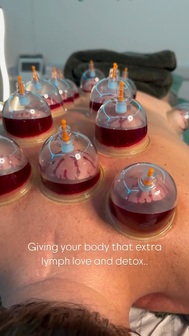 This is the ultimate detox, full body lymphatic and wet cupping placed in such a way it’s designed to maximise the detox and drain. Purging the body of all toxins, paired with a juice cleanse after this wow, your body will be brand new. Moving stagnant fluids and pushing toxins out of the body, it’s time to purge! Healthy mind healthy body 🫶🏻
🤍 book on our ritual treatment - Lymph & flow - two of my most significant treatments combined to bring you the best..
#postsurgical #surgerylife #liverpoolsurgery #drainagelymphatique #massage #afterlipomassage #tummytuck #loveyourbody #woodtherapytools #aftersurgerylook #postsurgerylife #liverpoollymphaticdrainagemassage #woodtherapymassage #lymph #postsurgeryrecovery #ibsawareness #postsurgerymassage #detoxyourbody #presurgery #lymphaticsystem #liverpoollymphaticdrainagemassage #liverpoolsportsmassage #antiwrinke #liverpool #detoxmassage #massageliverpool #beautyliverpool #lymphaticdrainagemassage #liverpoollymphaticdrainagemassage #lymphayicsystem