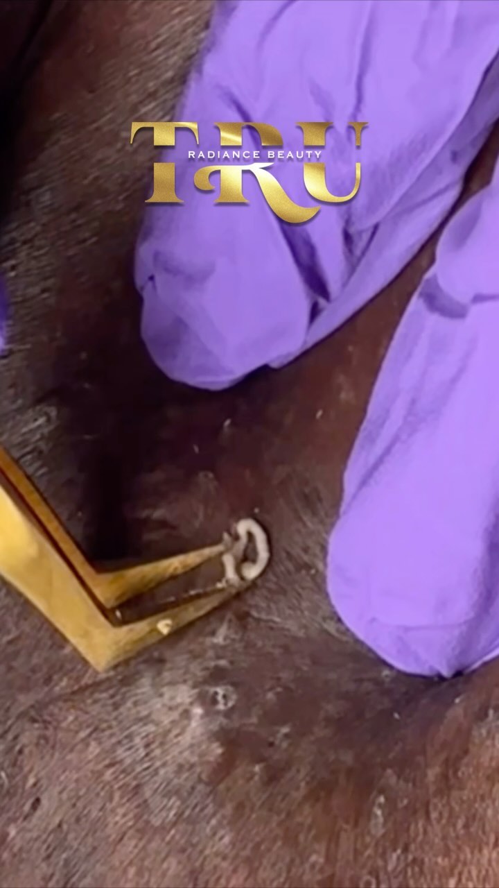 New client alert ‼️Where are my extraction watching lovers ? Like & Share if you want me to post the full video !
#extractions #oddlysatisfying #pimplepopper #blackheadextractions #cloggedpores #ingrown