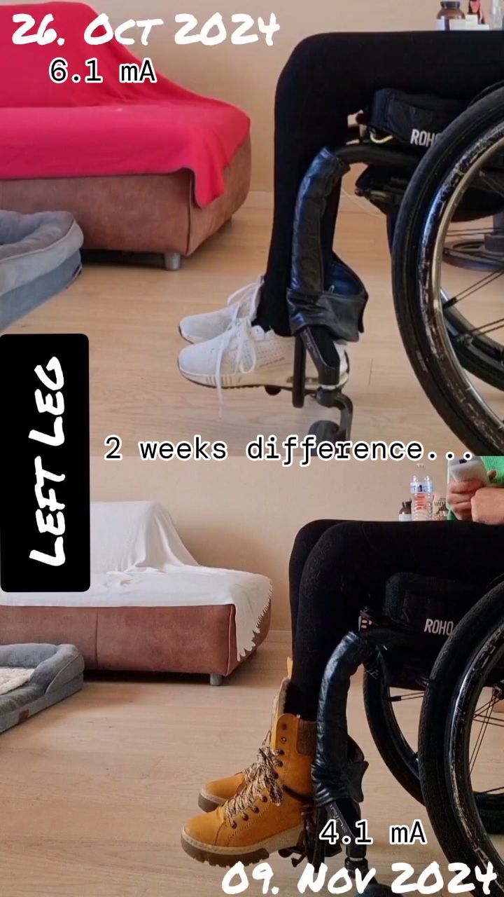 Even though I'm a complete paraplegic, this video shows the muscle training - left leg - đŠ” after an implantation of a pacemaker connected to my pelvic nerves. With a remote, I can initiate the stimulation of the nerves to train and grow the muscles.
.
#spinalcordinjury #lionprocedure #marcpossover #rollstuhl #querschnittslÀhmung