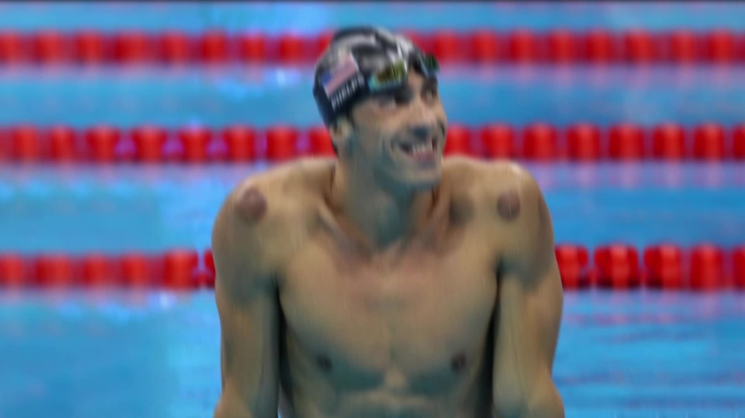 Cupping Therapy for Pain Relief!
Discover the science behind this ancient practice and how it can alleviate various types of pain. From muscle soreness to chronic conditions, Cupping Therapy offers a holistic approach to managing discomfort.
Learn about the mechanisms through which Cupping Therapy works to relieve pain. Explore how the suction created by the cups stimulates blood flow, reduces inflammation, and promotes relaxation in the affected areas. Gain insights into why this centuries-old technique continues to be valued for its therapeutic benefits.
Explore how Cupping Therapy can be integrated into your pain management routine. Whether you're seeking relief from sports injuries, tension headaches, or back pain, Cupping Therapy offers a natural and non-invasive solution. Stay connected with HTM Clinic for more informative content on health and wellness.
.
.
𝗩𝗶𝘀𝗶𝘁 𝗢𝘂𝗿 𝗪𝗲𝗯𝘀𝗶𝘁𝗲
https://www.htmplsg.com/
𝗖𝗼𝗻𝘁𝗮𝗰𝘁 𝗨𝘀
+65 9007 2812
.
#cupping #cuppingtherapy #cuppingtherapy❤️ #cuppingtherapybenefits #painrelief #painrelieftherapy