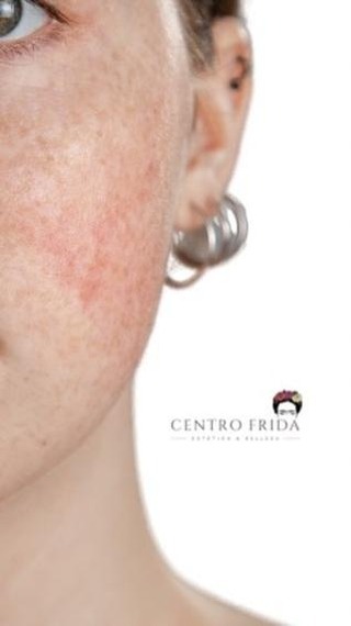 El Plasmapen es un dispositivo que se utiliza para realizar procedimientos de rejuvenecimiento de la piel y corrección de imperfecciones. Este tratamiento se basa en la tecnología de plasma, que utiliza una corriente eléctrica para crear pequeñas lesiones en la piel sin dañar los tejidos circundantes lo que provoca la contracción de la piel y estimula la producción de colágeno
El tratamiento con Plasma Pen se utiliza comúnmente para reducir la apariencia de arrugas, líneas finas, cicatrices, estrías, manchas de la edad y otros problemas de la piel. También puede utilizarse para tensar la piel en áreas como los párpados, el cuello, la frente, y alrededor de la boca.
¿Quieres saber más? 👀
Escríbenos y te contamos más detalles. Además hacemos valoraciones online y presenciales gratuitas 😃
Centro Frida 🌸🌺🌼
Estética & Belleza
Whatsaap 📲624252194
••••••••••••••••••••••••
#plasmapenmadrid #dermapenmadrid #esteticamadrid