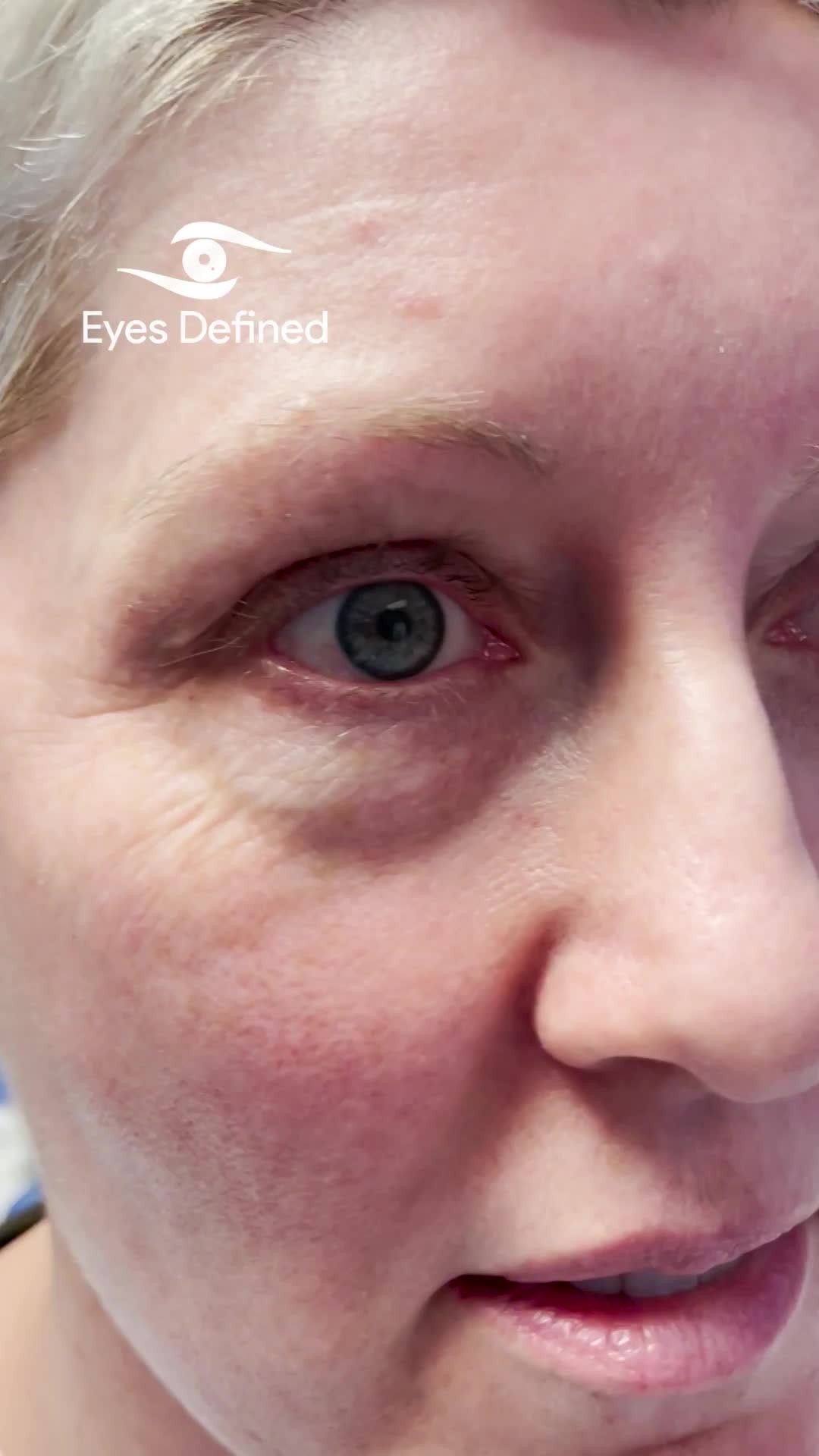 β¨ Transform your look with confidence! β¨ Check out this before and after of a scarless lower eyelid transconjunctival blepharoplasty with fat repositioning. ποΈβ¨ Say goodbye to tired eyes and hello to a refreshed appearance! π
Curious about how this procedure can enhance your beauty? π DM us for more info or to schedule a consultation! Your journey to youthful eyes starts now! π¬π©βοΈ #Blepharoplasty #EyeTransformation #YouthfulGlow #ConfidenceBoost #transconjunctivalblepharoplasty