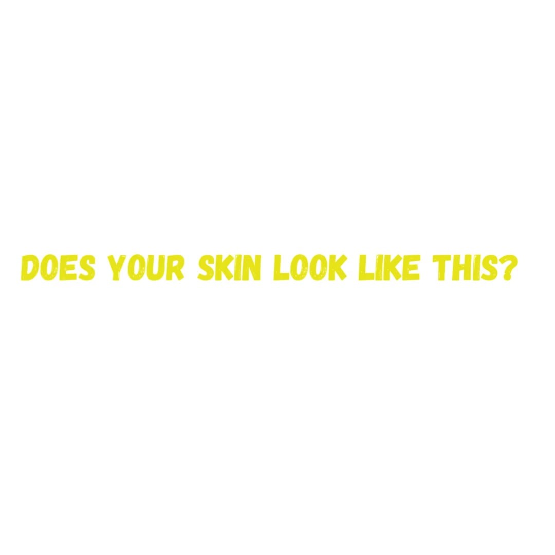 Has the summer left your skin feeling High and Dry? Show your skin some love and get the GLOW that you deserve with a #Hydrafacial#Hydrafaciallove##skingeek#Skinlove#selflove#selfcare#freshskin#glowingskin#skinglow