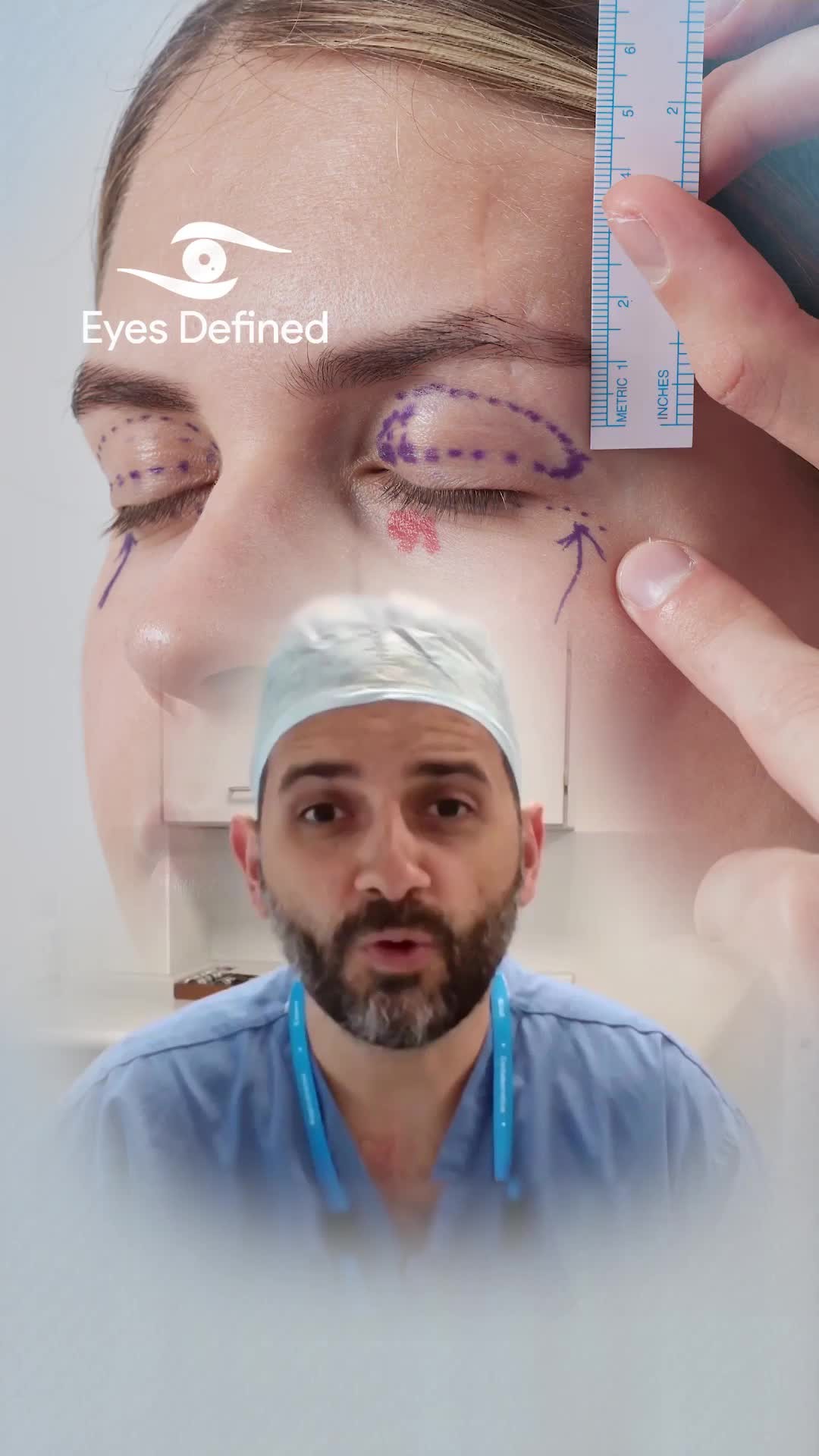Precision matters. 👁️✨
With years of experience in upper and lower eyelid surgery, I believe the secret to natural, refined results lies in the details—especially the suturing. It's where I spend the most time, because that's where artistry meets science. Every stitch is placed with purpose to ensure minimal scarring and optimal healing.
Blepharoplasty isn't just about removing excess skin—it's about restoring balance, brightness, and confidence.
📍 Based in London | Specialist in Oculoplastic Surgery
#BlepharoplastyLondon #EyelidSurgery #OculoplasticSurgeon #LondonAesthetics #UpperEyelidSurgery #LowerEyelidSurgery #EyelidRejuvenation #NaturalResults #FacialAesthetics #SubtleEnhancement #EyelidExpert #LondonSurgeon #PrecisionSurgery #Oculoplastics #PeriorbitalRejuvenation