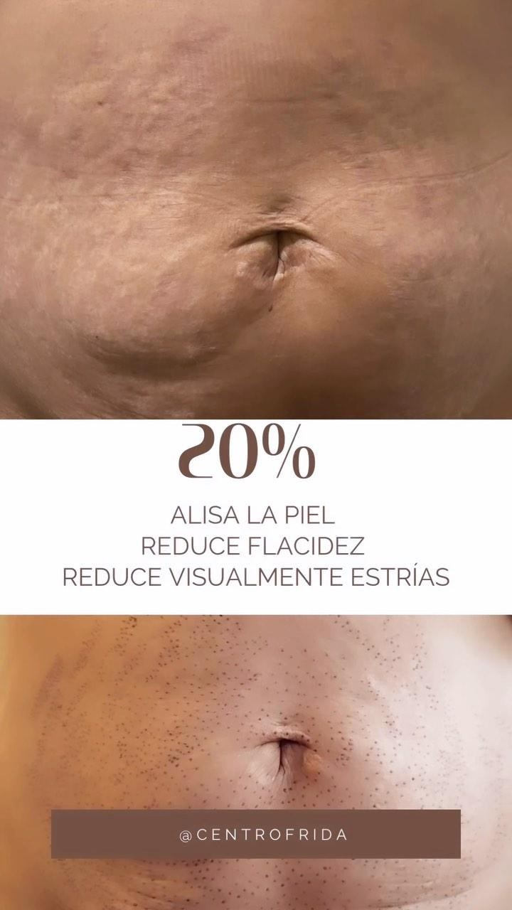 En Centro Frida tenemos el tratamiento perfecto para mejorar la piel del abdomen y ahora con un descuento especial de un 20% ‼️
Plasmapen alisa la piel, reduce la flacidez, y reduce visiblemente las estrías.
No requiere anestesia, suturas o vendajes.
Requiere un tiempo de inactividad mínimo.
¿Quieres saber más?
Ponte en contacto con nosotros y te resolveremos todas las dudas 😊
Centro Frida 🌸🌺🌼
Estética & Belleza
Whatsaap 📲624252194
••••••••••••••••••••••••
#plasmapenmadrid #dermapenmadrid #esteticamadrid