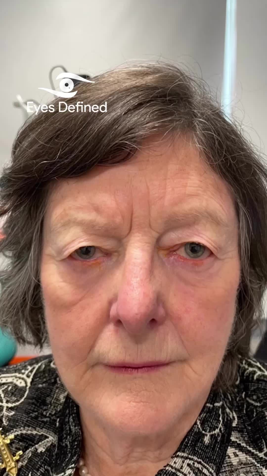 This upper eyelid blepharoplasty removed the heavy hooding that was hiding her stunning blue eyes. The result? A natural, rested appearance that simply looks like a better version of *you.*
No one needs to know you had surgery — they'll just notice how well you look.
#Blepharoplasty #UpperEyelidSurgery #OculoplasticSurgeon #NaturalResults #RefreshedNotDone #EyelidRejuvenation #LondonAesthetics #BrightEyes #UpperLidLift #EyelidTransformation #BlepharoplastyBeforeAndAfter #SubtleEnhancement
