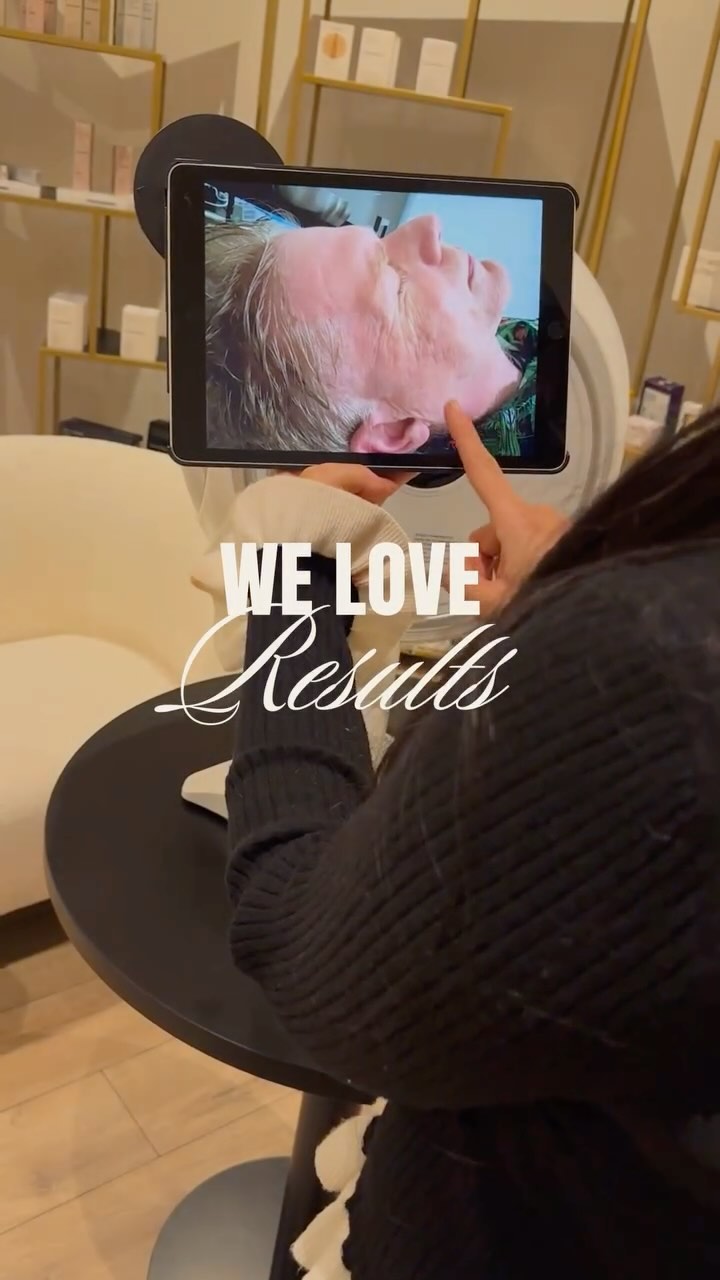 We Love Results 😍
Je kent het vast wel…je ondergaat een huidbehandeling, maar er wordt niet gekeken naar jouw huidtype, huidskleur, dagelijkse routine, of een belangrijke factor – of je een man of vrouw bent. Mannen en vrouwen verschillen namelijk enorm in hoe hun huid reageert, van downtime tot huidverzorging. Bij ons pakken we het anders aan.
Wij zijn GEEN standaard huidkliniek. Geen standaardoplossingen. Wat wij doen, is kijken naar JOUW unieke huid en jouw levensstijl. Wat je hier ziet, is het resultaat van ons Anti-Aging Therapy Plan – volledig afgestemd op de persoon achter de huid.
Waarom zijn we anders? Omdat we geloven in maatwerk. Bij ons krijgt iedere huid een aanpak die past, met blijvende resultaten als doel:
✨ Acne Therapy Plan – voor een rustige, zuivere huid.
✨ Pigment Therapy Plan – om donkere vlekken te vervagen.
✨ Hair Recovery Plan – voor voller, gezonder haar.
✨ Hydra Therapy Plan – voor diepe hydratatie en een glow.
✨ Skin Texture Plan – voor een gladde, egale huid.
En zo hebben we nog meer Personal Therapy Plans, allemaal speciaal ontworpen voor jouw huid en behoeften.
Wist je dat je een preview van het algemene plan kunt downloaden? Stuur ons een WhatsApp en ontvang direct een kijkje in onze aanpak. Jouw persoonlijk plan? Dat krijg je exclusief tijdens je afspraak.
Stuur ons een bericht met “INFO” voor meer details of om direct te boeken.
- Alles wat je nodig hebt, vind je via de 🔗 in onze bio.
Boek online een afspraak: www.thehagueclinic.nl
📞 Bel: 085 060 74 77
📧 E-mail: info@thehagueclinic.nl
LIKE, SAVE & FOLLOW als jij klaar bent voor jouw huidtransformatie.
🤍 @thehagueclinic