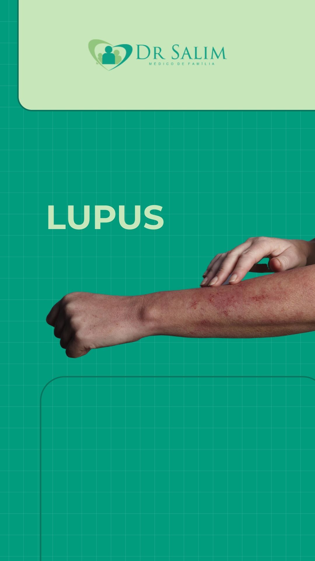 Fevereiro Roxo: Mês de Conscientização sobre o Lupus!
Mesmo com fevereiro chegando ao fim, é importante continuarmos falando sobre essa doença.
Neste vídeo, compartilho informações sobre o lupus, uma doença autoimune que afeta principalmente mulheres jovens.
Com sintomas variados, como fadiga, dores articulares e erupções cutâneas, o lupus requer atenção especializada de reumatologistas e imunologistas.
Mas lembre-se, o lupus tem controle! Com tratamento adequado e acompanhamento médico, é possível viver uma vida plena mesmo com a doença.
Se você suspeitar que pode ter lupus, não hesite em procurar ajuda médica. Juntos, podemos cuidar da sua saúde e bem-estar.
Nos vemos no próximo vídeo! Até lá!