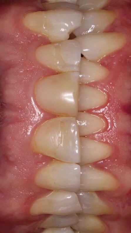 Diseño de Sonrisa, 6 carillas de Porcelana
Sonríe con confianza y descubre una sonrisa radiante, nuestros tratamientos transformarán tu sonrisa!