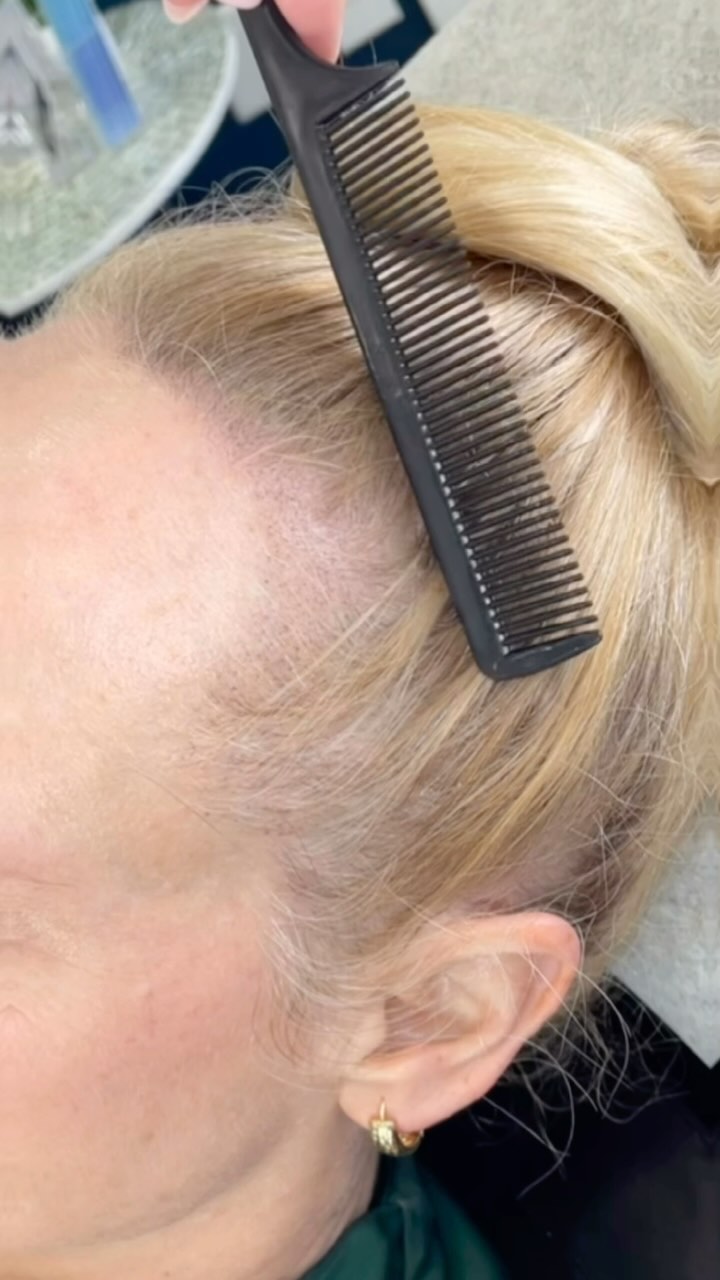 โจSMP HAIRLINE DENSITYโจ
And on a blonde!!! ๐๐ผ๐๐ผ๐๐ผ๐๐ผ
This client was concerned about her thinning hairline, so we did a few sessions of Scalp Micropigmentation - and this is the healed result.
We mapped around her existing baby hairs and blended some SMP to give the illusion of a more dense hairline.
We numb the scalp before to keep it comfortable, and healing for this procedure is very quick.
Time to rock the buns & ponytails every daaaayy!! Gonna start a #PonyTailGang ..Who wants to join? ๐๐ผโโ๏ธ
Drop any questions or a โค๏ธ in the comments if you like it!
#smp
#hairloss
#hairlossawareness
#scalptattoo
#hairrestoration