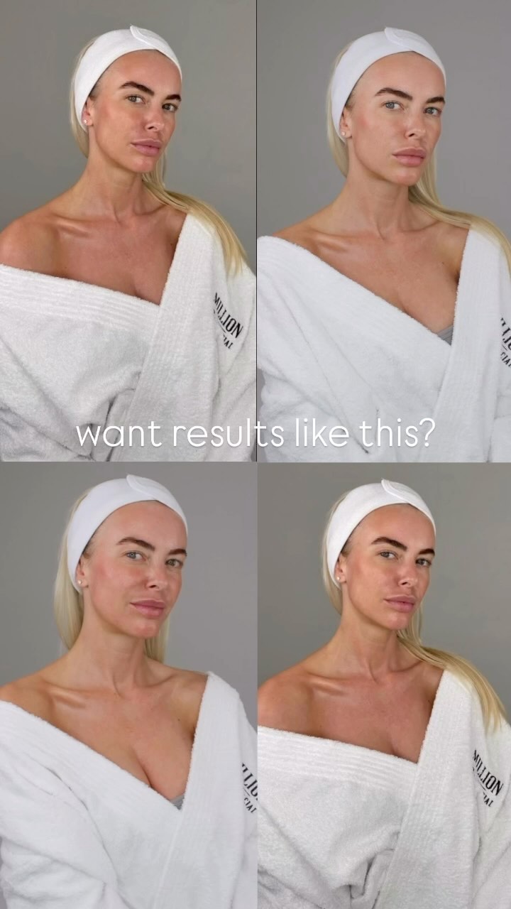 Microneedling (collagen induction therapy) is used to treat and improve conditions like acne scarring, fine lines and wrinkles, loose skin, skin texture, pore size, brown spots and pigment issues.
Working with our bespoke products with full clinical evidence the products and treatment combined are a real powerhouse for results.
💥Benefits
Stimulating fibroblasts within the skin causes the skins cell renewal process. Elevated with our potent Mesotherapy ampoules to tailor the treatment to your skin’s needs.
🌟Eliminate – Provides an anti-inflammatory and antimicrobial effect to not only calm and sooth inflamed skin but also inhibit proliferation of bacteria making this blend so useful in the prevention of breakouts. Speeding up the wound healing process
🌟Radiate - Protects against external factors of contamination achieving a radiant and revitalized complexion. The protective functions help to prevent skin damage caused by exposure to harsh environmental factors like UV radiation, pollution, smoke, and irritants.
🌟Rejuvenate - enhances cell regeneration and can reduce wrinkles by providing energy to the cells to achieve an oxygenated epidermis. Providing hydration and plumpness without weighing down the skin, it fortifies and protects the skins barrier so can be effective in retaining moisture helping to minimise fine lines and wrinkles and improve acne scaring.
Leaving you with radiant and healthy skin!
🌟Multiple sessions are required for best results,
🌟Sessions can be repeated every 4-6 weeks
#skincare #collagen #skinconfidence #fibroblast #treatment #selfcare #skin