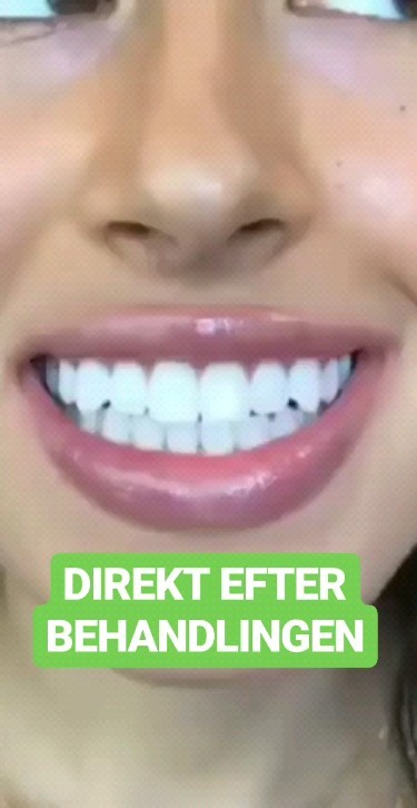 Klinik Tandblekning 
ERBJUDANDE 995 KR (Ordinarie pris 4900 kr)
ONLINE TIDSBOKNING
www.DentalClinicSweden.org🔺️
 #tandblekningstockholm #TandblekningStockholm #stockholm #liljeholmen #KlinikTandblekning #TandblekningGöteborg #TandblekningUppsala #TandblekningUtbildning #fillers #fillersstockholm #fillersgöteborg #fillersmalmö #TandblekningsUtbildning #fillersstockholm #russianlipsstockholm