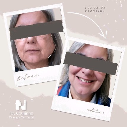 Transformação e precisão na cirurgia de cabeça e pescoço: antes, durante e depois de uma parotidectomia. 🙌🏻
Estas imagens capturam não apenas a mudança visível, mas o cuidado necessário para proteger o nervo facial durante a cirurgia, preservando a mímica e expressões faciais.
Atingir objetivos terapêuticos, funcionais e estéticos não é opcional, é mandatório!
Orgulhamo-nos de restaurar a saúde enquanto mantemos a integridade estética e funcional.
#CirurgiaDeCabeçaEPescoço
#Parotidectomia
#ArteECiência