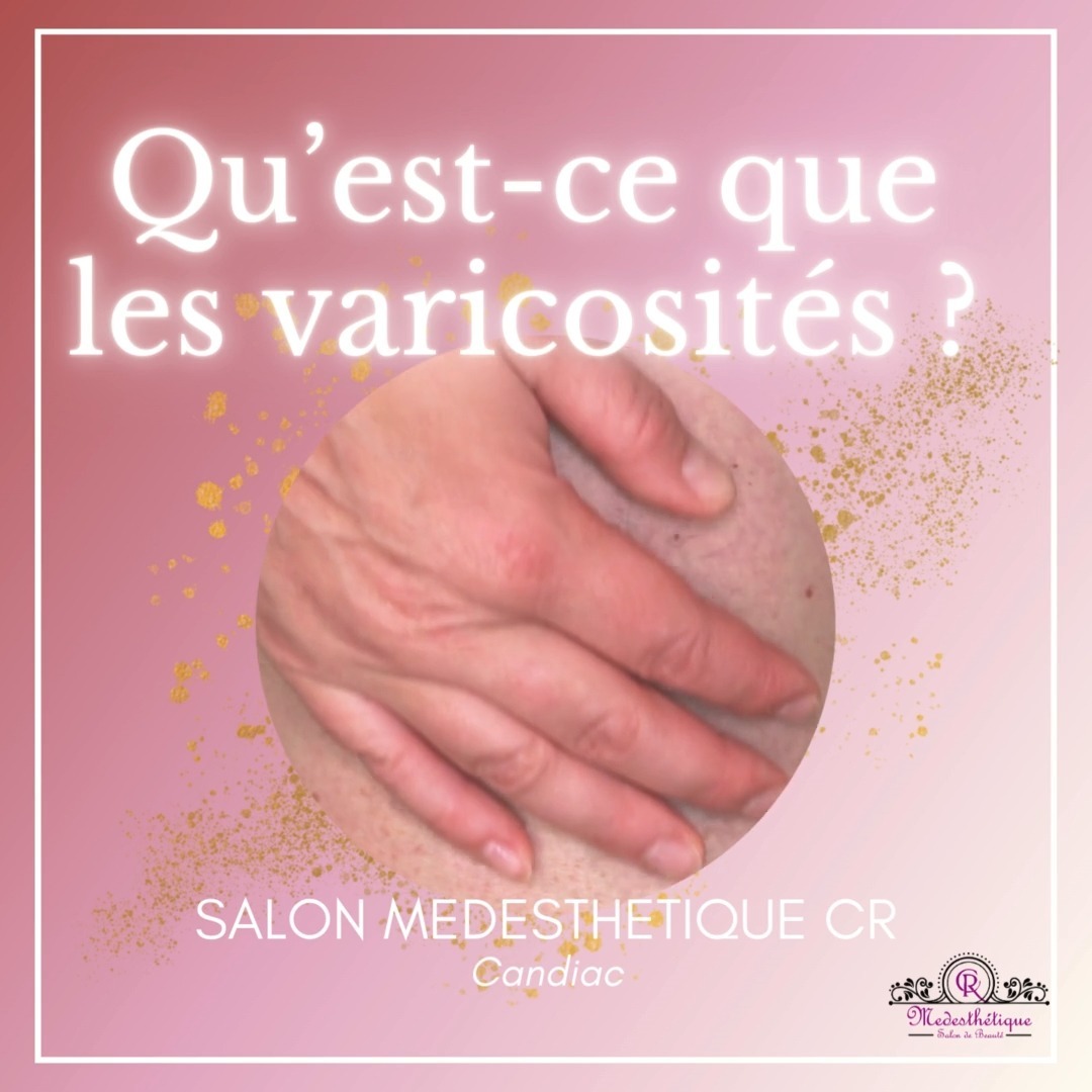 🌿 Infrathérapie & Laser pour les varicosités : des soins ciblés pour une meilleure circulation
Offerts chez Medesthétique CR à Candiac
❓Qu’est-ce que les varicosités ?
Les varicosités sont de petits vaisseaux sanguins dilatés, visibles à la surface de la peau, souvent rouges, bleus ou violets. Elles se manifestent surtout sur les jambes, mais aussi sur le nez et les joues. Ces capillaires apparents résultent d’une mauvaise circulation sanguine, souvent aggravée par :
✔️Le stress
✔️Une alimentation riche en toxines
✔️La pollution
✔️Le manque d’activité physique
💡 Deux solutions efficaces chez Medesthétique CR
🔴 1. Le traitement laser pour varicosités
Ce soin cible les varicosités par un faisceau lumineux précis qui chauffe et coagule les petits vaisseaux dilatés, favorisant leur disparition naturelle.
✔️ Idéal pour les jambes, les cuisses et les petits vaisseaux visibles sur le nez et le visage
✔️ Procédure rapide et non invasive
✔️ Aucune éviction sociale
👉 Plusieurs séances sont nécessaires pour des résultats optimaux, selon la quantité, la profondeur et la couleur des vaisseaux. Un plan personnalisé vous sera proposé lors de la consultation.
🔥 2. L’infrathérapie corporelle
Un soin par chaleur infrarouge qui pénètre jusqu’à 4 cm sous la peau, stimulant :
🌟La circulation sanguine et lymphatique
🌟L’oxygénation des tissus
🌟L’élimination des toxines
🌟Le raffermissement cutané
L’infrathérapie agit en complément du traitement laser pour renforcer les résultats, soulager les jambes lourdes et améliorer l’aspect global de la peau.
💪 Les bienfaits combinés
✅ Stimule la circulation sanguine et lymphatique
✅ Réduit la visibilité des petits vaisseaux (nez, jambes, cuisses)
✅ Affinage de la silhouette et peau plus ferme
✅ Élimination des toxines et métaux lourds
✅ Amélioration du teint, de l’élasticité et de l’hydratation de la peau
✅ Soulage les douleurs musculaires et les tensions nerveuses
⚠️ Contre-indications de l’infrathérapie
🚫 Femmes enceintes
🚫 Médication pour l’hypertension
🚫 Blessures articulaires récentes (attendre la disparition des symptômes aigus)