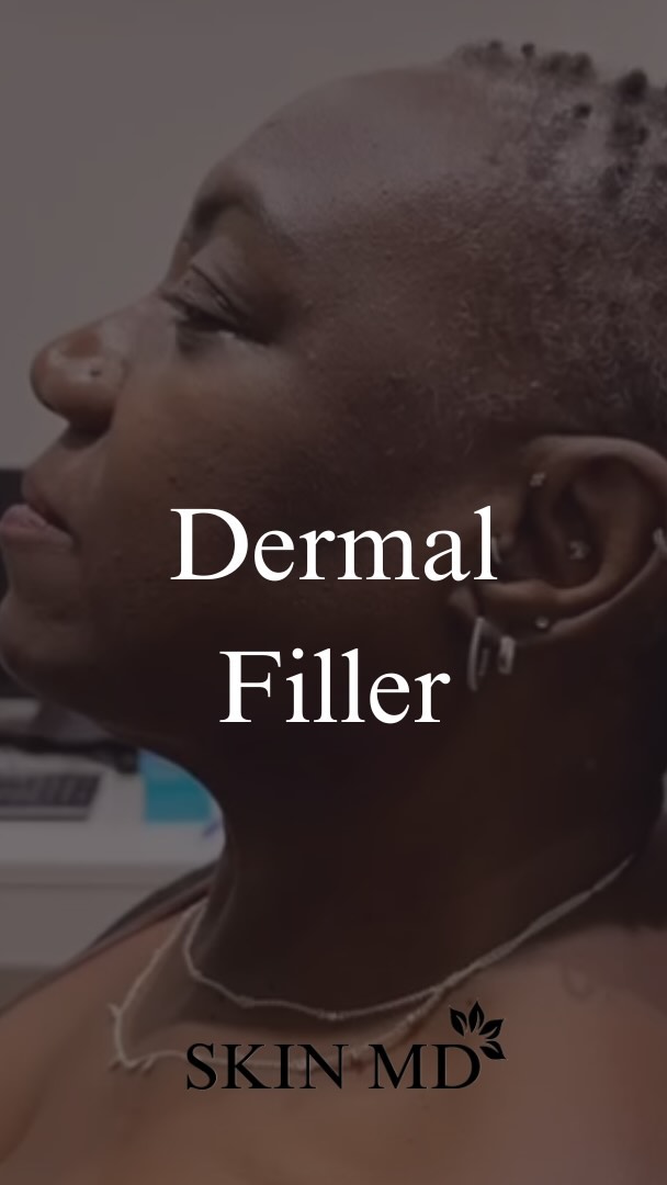 Ready to enhance your natural beauty? Discover the magic of dermal fillers! Whether you’re looking for subtle volume, smoother lines, or a youthful glow, our expert team has you covered. 💉 Book your consultation today and let your radiance shine! 💖#dermalfiller #beautyboost # glowup #aestheticenhancement