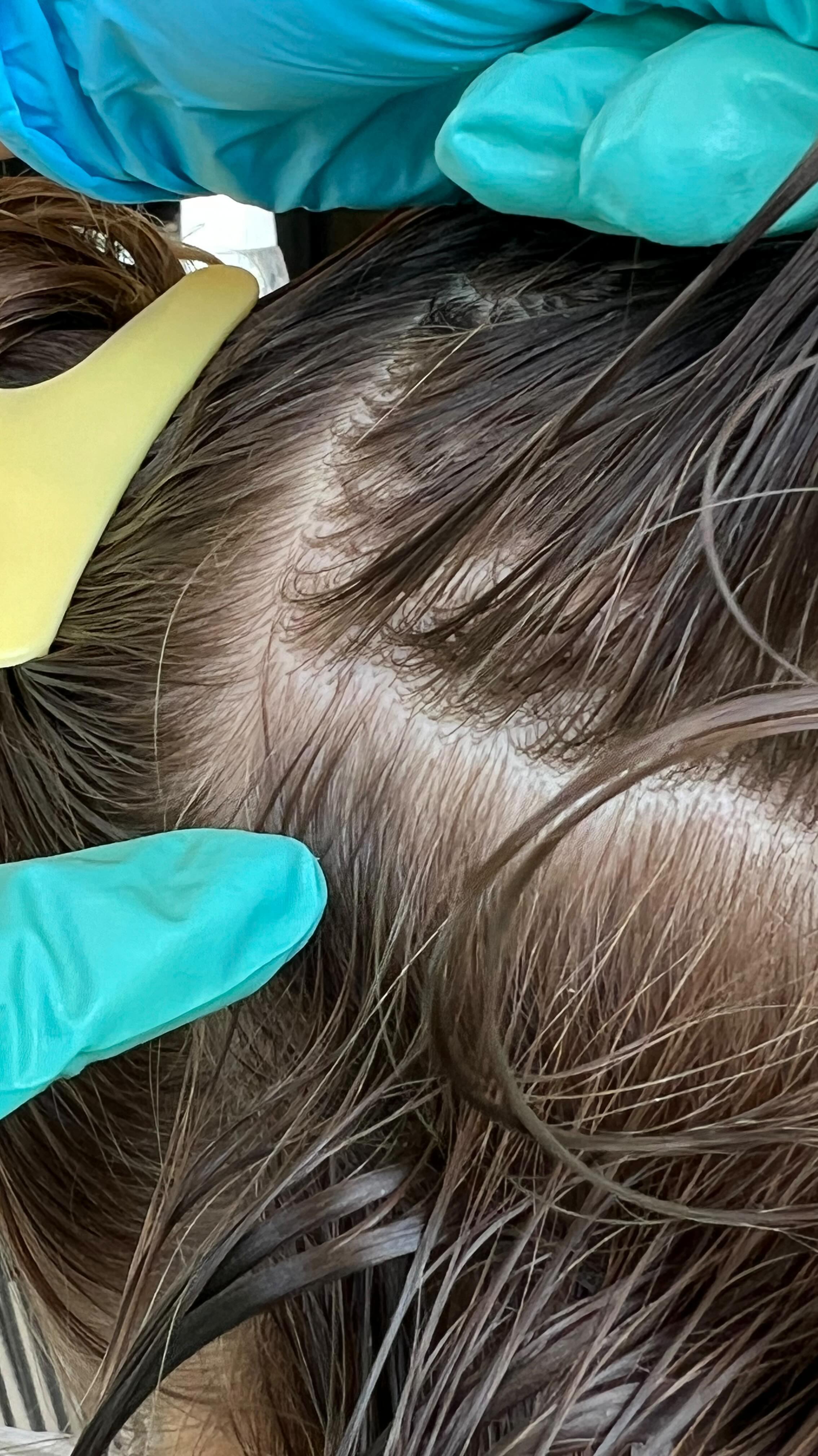 Wondering how head lice spread? 🕵️♂️ Here are 5 common ways they can move from person to person! 🧢👒🛏️ Keep these in mind to protect yourself and your loved ones. #HeadLice #Prevention #StayInformed #HealthyLiving