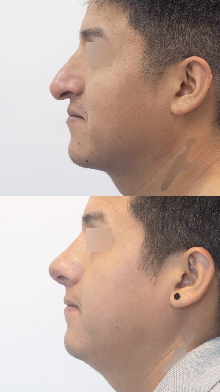 💉Rinoplastia
⏰2 meses de evolución
En esta ocasión, nos complace presentarles este impresionante resultado, ¡Sabias que la nariz y las orejas se demoran hasta 6 meses en terminar de desinflamar y poder ver los resultados reales! 💞 #rinoplastia