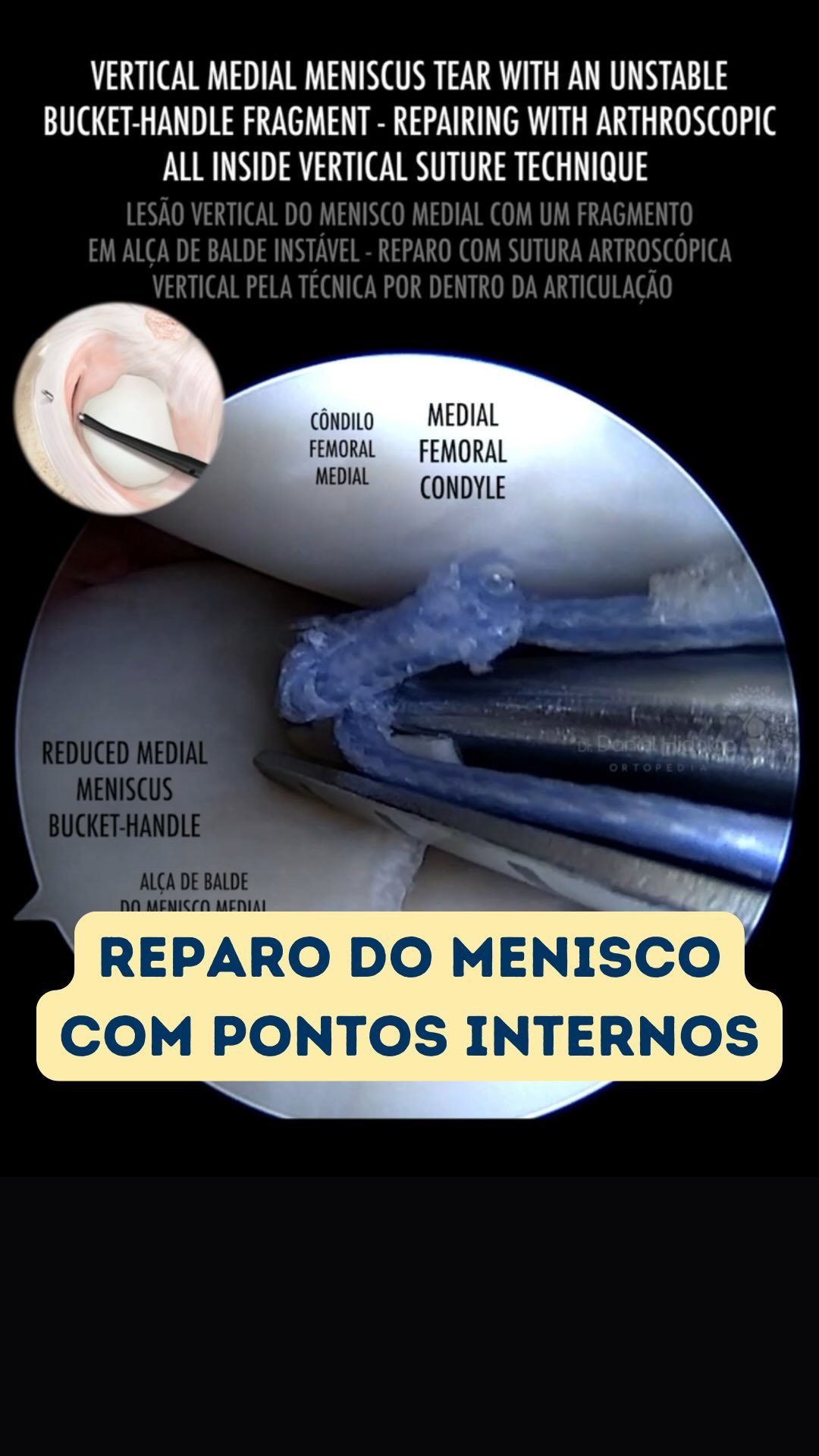 🪡 O reparo do menisco com pontos por dentro do joelho. Meniscus repair with all-inside stitches. #meniscus #arthroscopy #knee