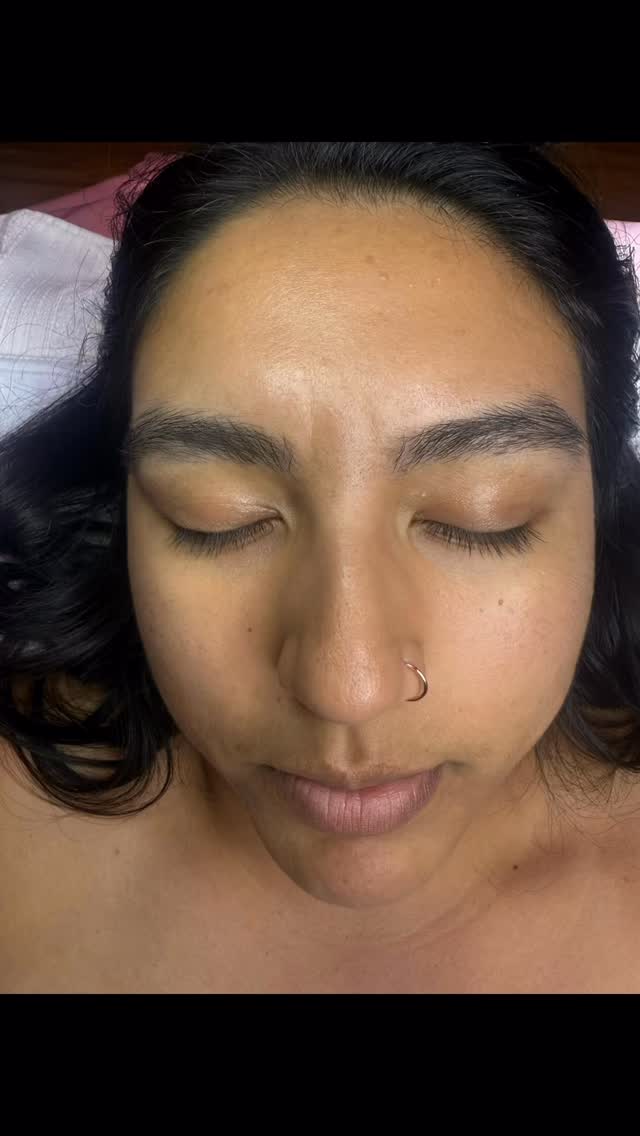 The before & after #Dermaplane facial