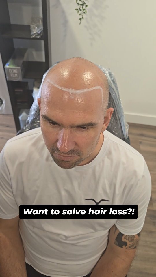 HAIR LOSS SOLUTION?!
SCALP MICRO-PIGMENTATION IS THE BEST HAIR LOSS SOLUTION YOU WERE UNWARE OF!
- RESULTS FROM FIRST SESSION
- HYPER-REALISTIC RESULTS
- UNDENIABLE ILLUSION OF REAL HAIR
- UNLIKE TRANSPLANTS - FOR ANY STAGE OF HAIR LOSS
- WORKS PRIOR OR IN CONJUNTION WITH A HAIR TRANSPLANT/PRP TO ADD DENSITY
- LOW MAINTENANCE
- MINIMAL TO NO DOWNTIME
- LESS PAINFUL THAN A TYPICAL TATTOO
- EACH SESSION IS AROUND 2 HOURS DEPENDING ON SIZE OF AREA
- COST EFFECTIVE IN COMPARISON TO OTHER HAIR LOSS SOLUTIONS
- NON INVASIVE/ NO SURGERY/ NO MEDICATION REQUIRED
COSMETIC TATTOO SPECIALISTS
📍Bury St Edmunds, Suffolk, UK
📍Brighton, UK
📍Colchester studio coming soon
#smp
#scalpmicropigmentation #prp #hairtransplant #hairloss #hairlosssolution #hairlosstreatment #balding #recedinghairline #thinninghair #rosemaryoil #explore #hairtrends #menshair #selfcare #selflove #confidence ##mensmentalhealth #hairtattoo #cosmetictattoo #Suffolk #Brighton