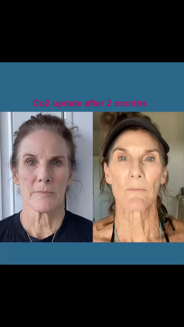 #capricebeautybar #theskingames2024 #age #tampabay #sarasotaflorida #medspa #skin #sarasota #veniceflorida #siestakeybeach #lolahodges #co2