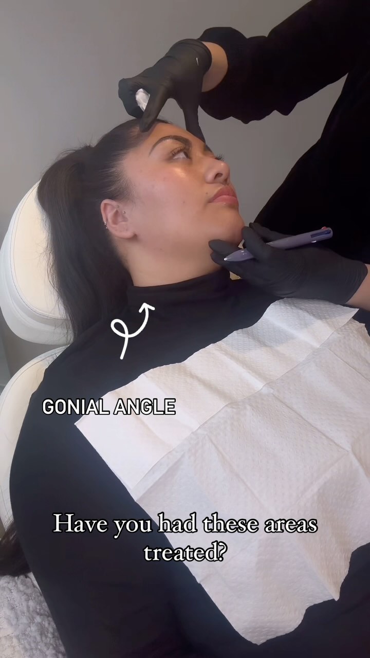Have you had these areas treated before? 💉
Why would you even get these areas treated?
Well… let me explain 😉
1. Gonial Angle: Beautiful treatment that gives a bit of definition to the jawline without it looking too “overpowering”. A problem that can arise with jaw filler for woman is if too much product is used this can potentially give the appearance of a squared/ angular jawline which can be perceived as more masculine. The Gonial angle is the junction between the neck and the jawline, by giving the Gonial angle a bit more definition it can give the appearance of a more defined jawline.
2. Piriform Fossa: This is a key treatment area that often gets over looked. This area of treatment is great to address the bony reabsorption process by placing appropriate filler deep onto periosteum to help bring back that mid face support. This treatment can also help improve the nasolabial folds and decrease the appearance of heaviness around the nose.
3. Lips: okay, this is probably the most common area of filler 😂 Lip filler is amazing for hydration, adding volume, improving facial symmetry and it can also give a more youthful appearance. The key with lip filler is making sure that we don’t just treat the lips…. We make sure that we look at the face as a whole and treat appropriately. Remember: Your face is not a trend!
Something else for you to remember is… yes, there’s many pros to getting treatment done HOWEVER cosmetic injectables is still a medical procedure and with pros there will always be potential cons aswell. So please make sure when you book in with your local injector that they explain everything. You have every right to know about the treatment and also the potential risks. This is how you’re able to make an informed decision. Do not feel afraid to ask questions. It’s our duty to be as transparent as possible. 💕
Dermal Filler, Medical Device Class III to smooth facial wrinkles and folds, correct facial atrophic scars, restore or enhance the lips, or restore facial volume. Dermal filler has risk and benefits. Ask your doctor if dermal filler is right for you.
#antiwrinkle #lipfiller #dermalfillers #confidence #cosmeticnurse