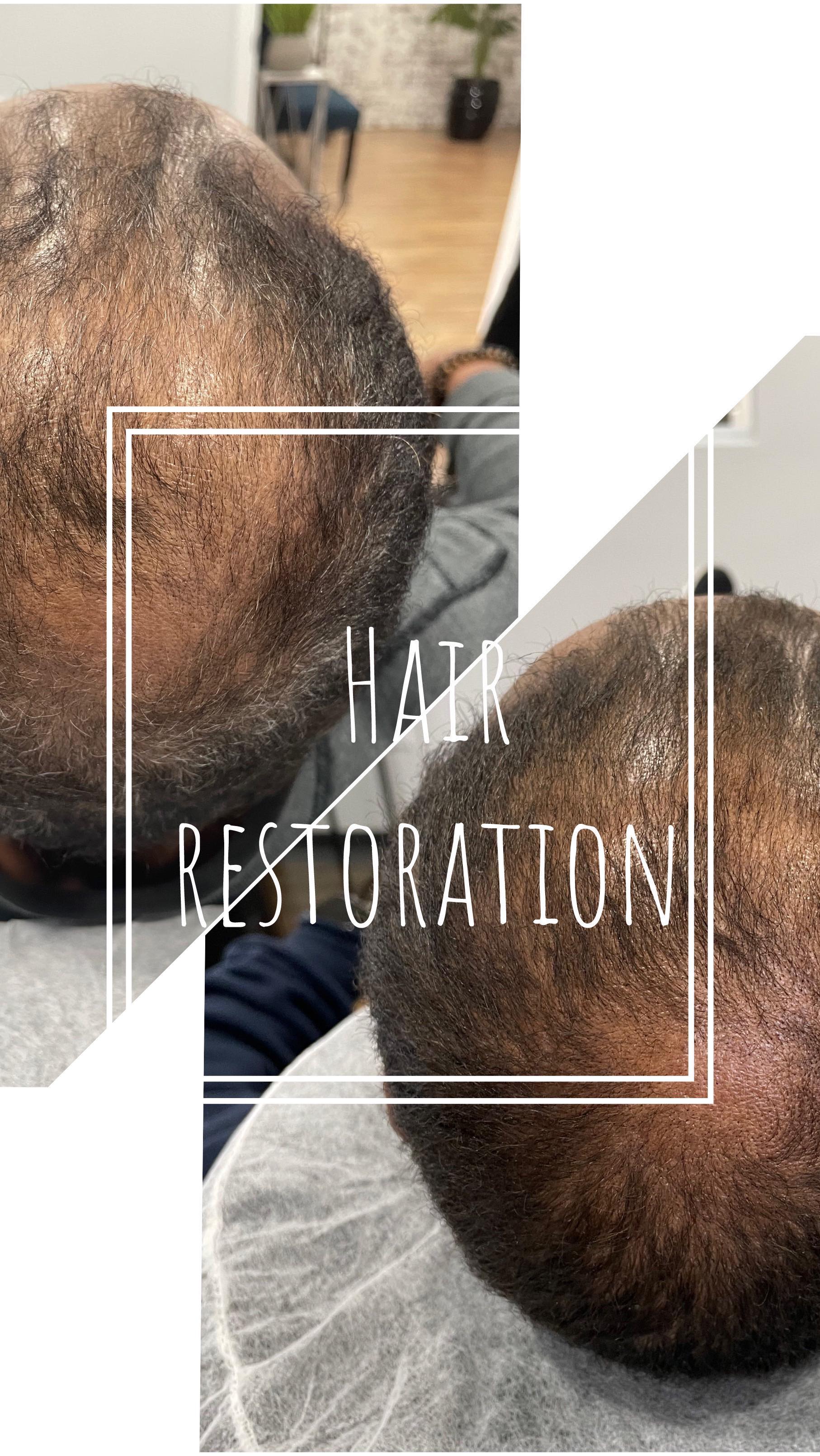 ⚡️ℍ𝔸𝕀ℝ ℝ𝔼𝕊𝕋𝕆ℝ𝔸𝕋𝕀𝕆ℕ ⚡️
Bringing back his OG hairs with TED treatments.
This is after only 2 treatments over 8 weeks!
Can’t wait to share more after our next follow up from the 3rd treatment.
💥Transepidermal delivery (TED) is completely painless and regrows your real hair.
💥3 treatments minimum are needed to initiate best results.
💥After the first treatment, you’ll notice less shedding. After the second treatment, hair follicles start to pop in new hairs, and after the third treatment you should start to notice more growth and overall density.
💥3 to 5 treatments for best results - varies, depending on hair loss and goals.
DM with any questions!
#hairloss #hairrestoration #hairtransformation #hairgrowth #alopecia