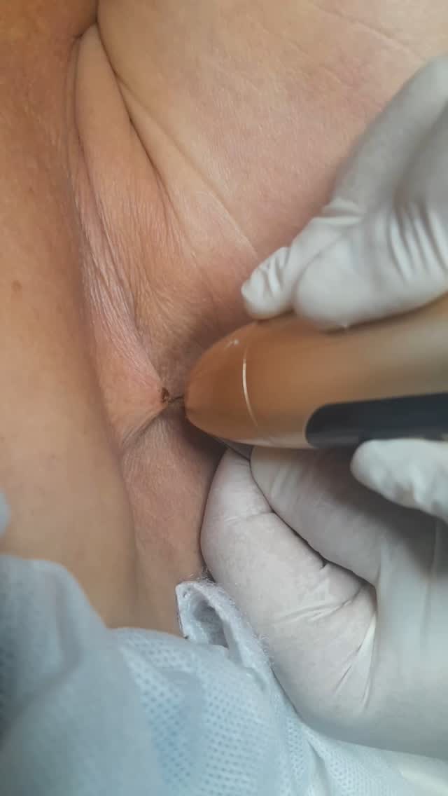 Cauterizacion de verrugas ✨️
Deshazte de ellas ,sin dolor , sin cicatrices de una manera eficaz y razonable con tu bolsillo
.
.
.
.
.
Cotiza con nosotros !!
Envía DM o WhatsApp al 6462041481 para recibir información sobre cotizaciones o dudas sobre el procedimiento pregúntanos!!😊✨️